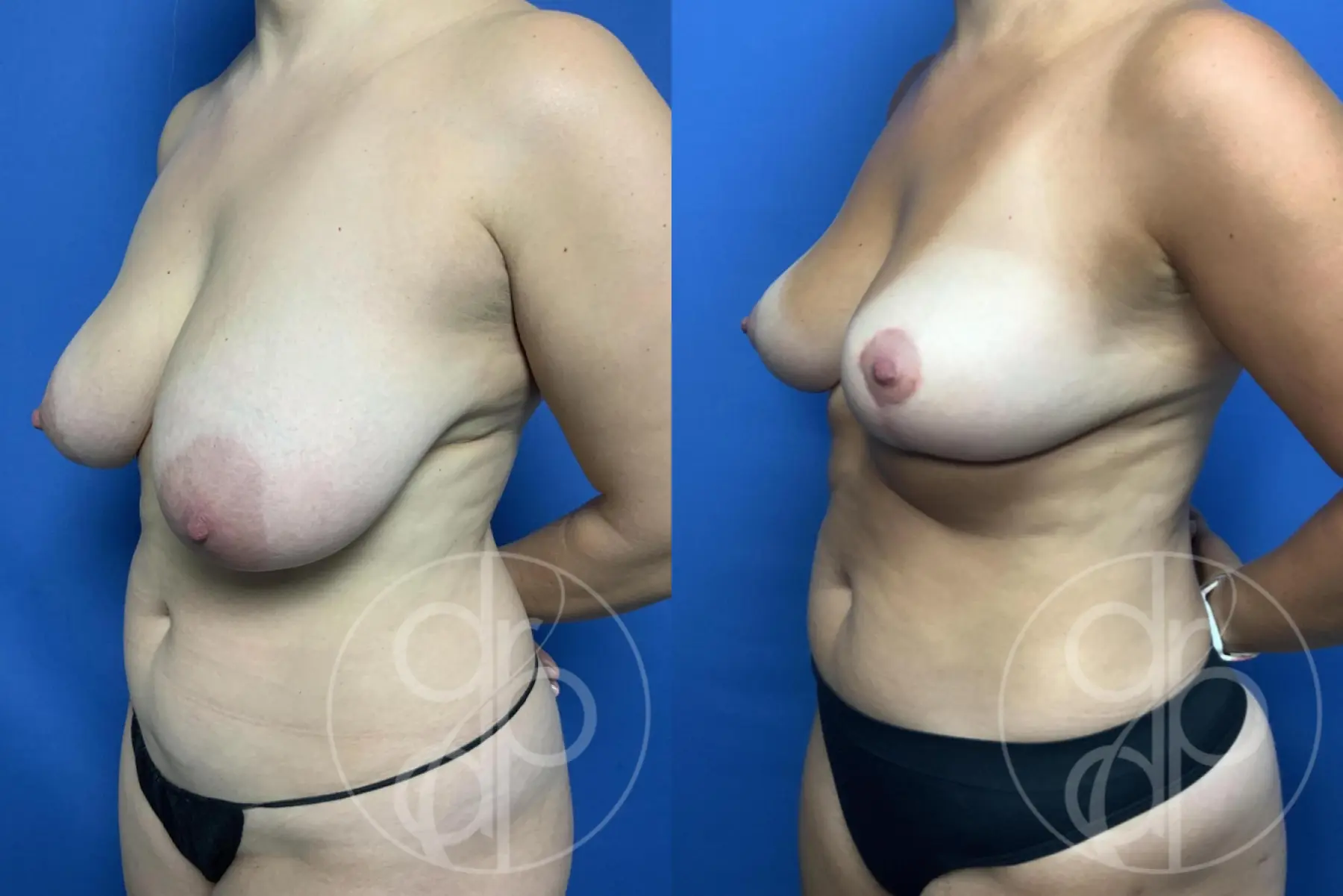 Breast Reduction: Patient 28 - Before and After 3