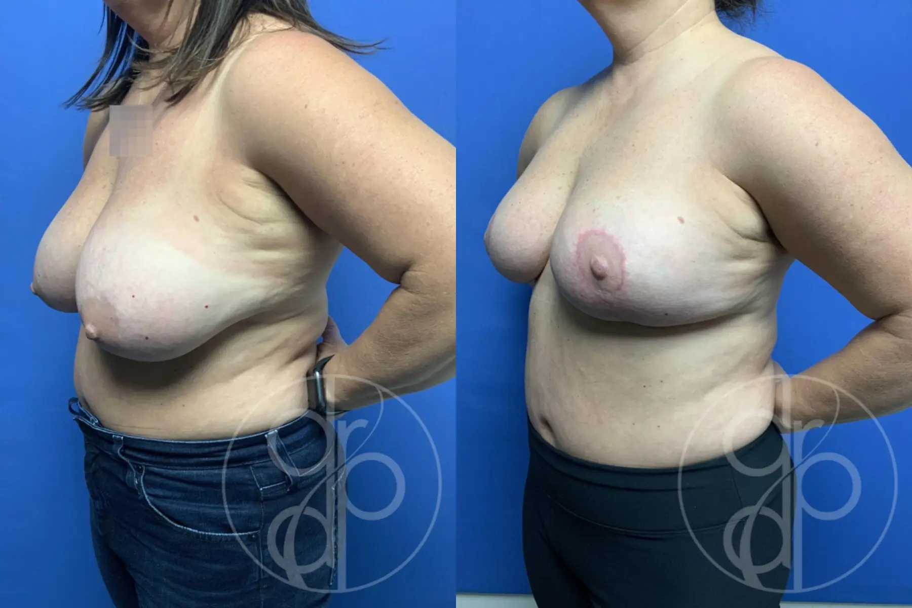 patient 13866 breast reduction before and after result - Before and After 3