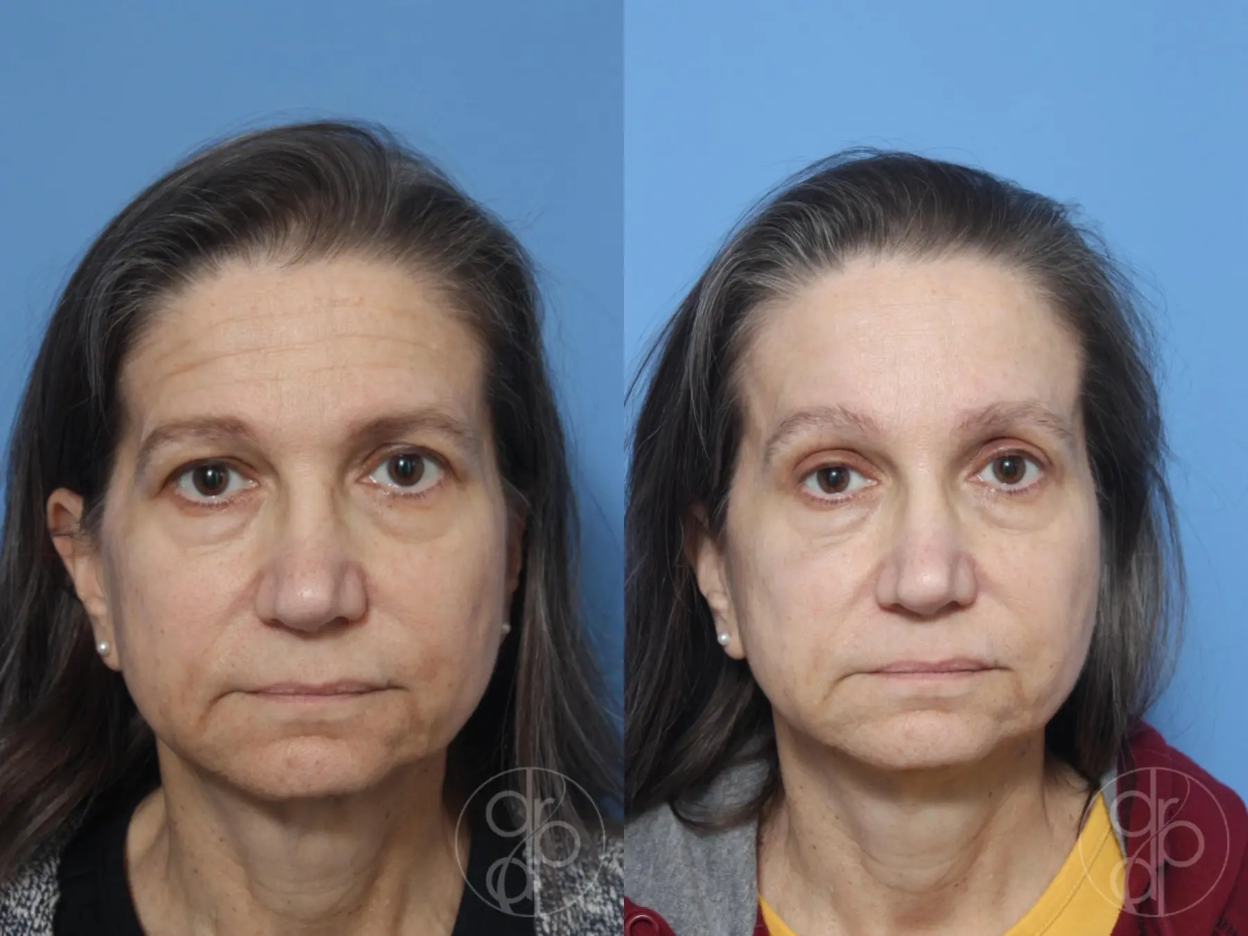 patient 12880 brow lift before and after result - Before and After