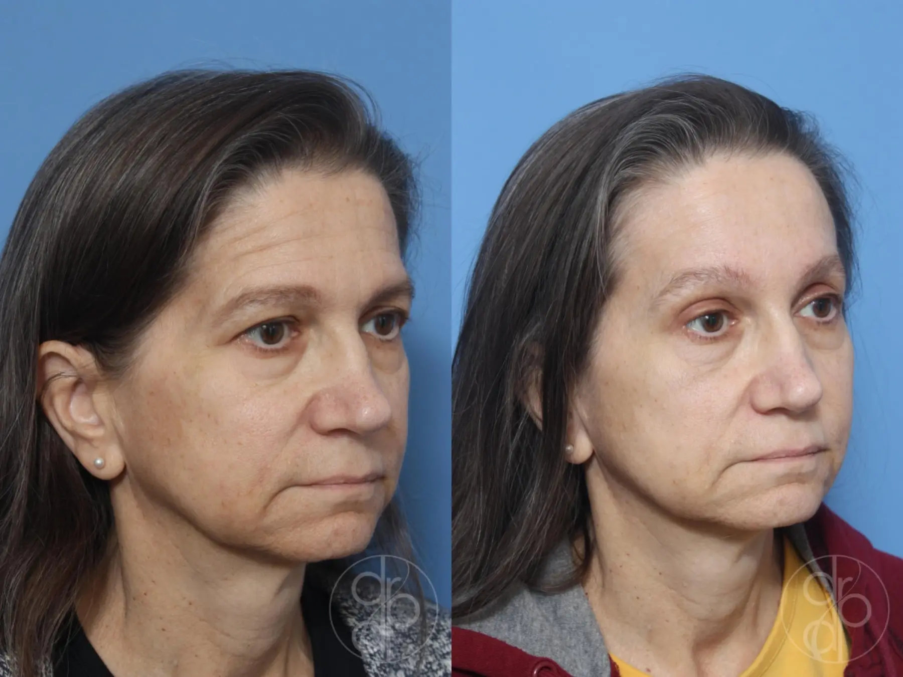 patient 12880 brow lift before and after result - Before and After 2