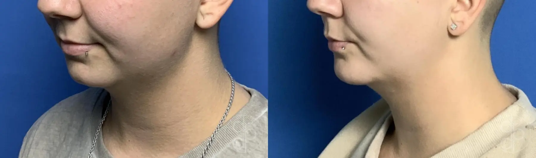 patient 12469 chin augmentation before and after result - Before and After 4