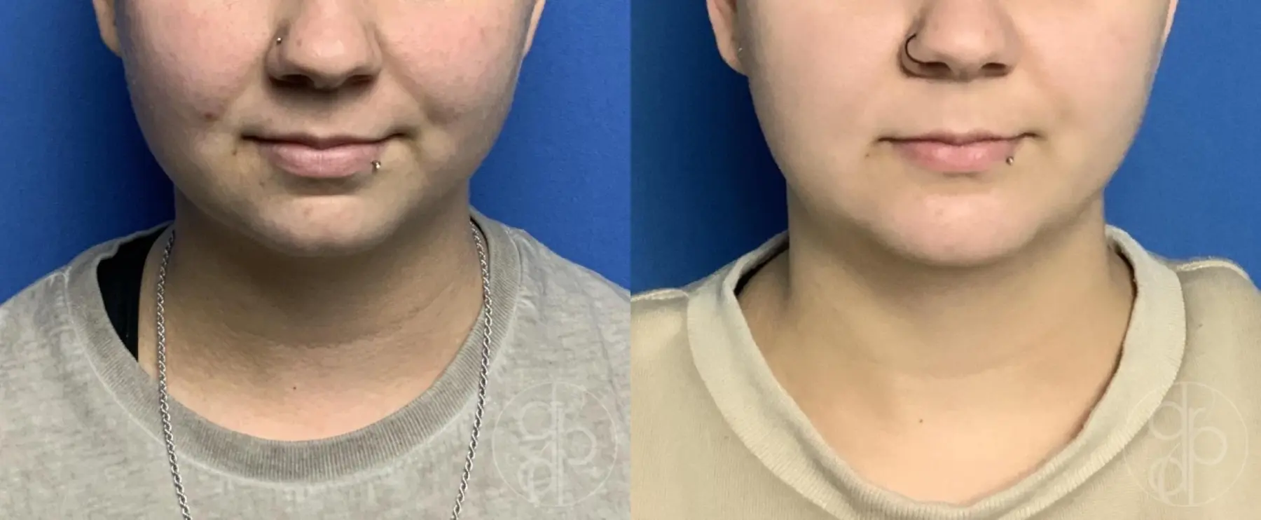 patient 12469 chin augmentation before and after result - Before and After