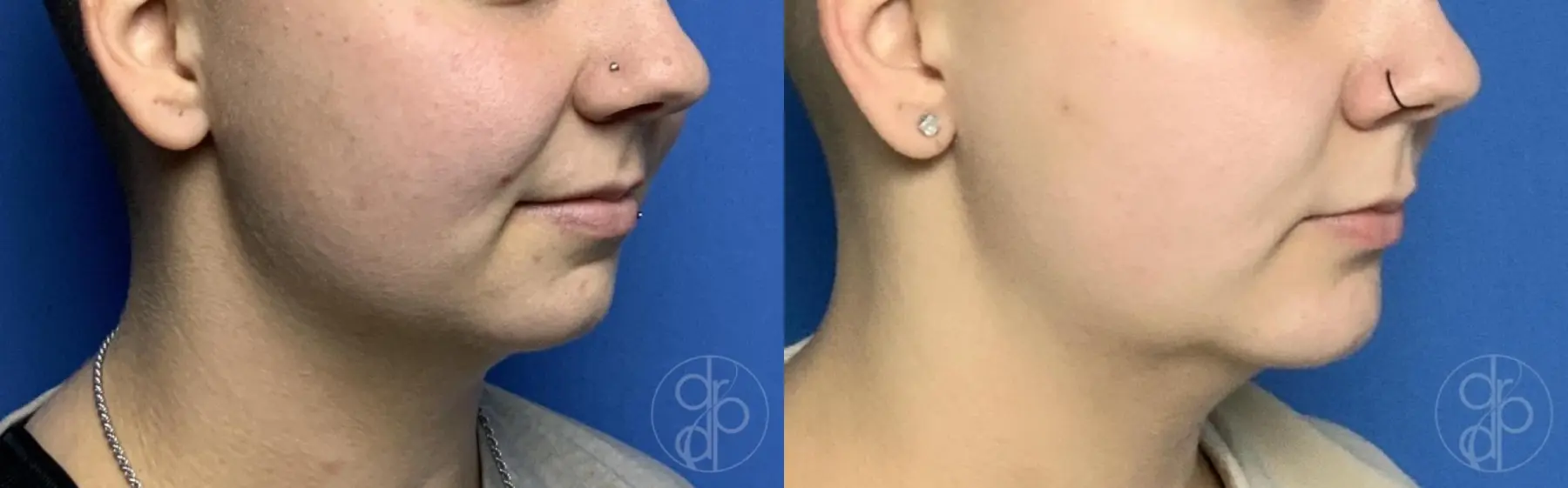 patient 12469 chin augmentation before and after result - Before and After 2