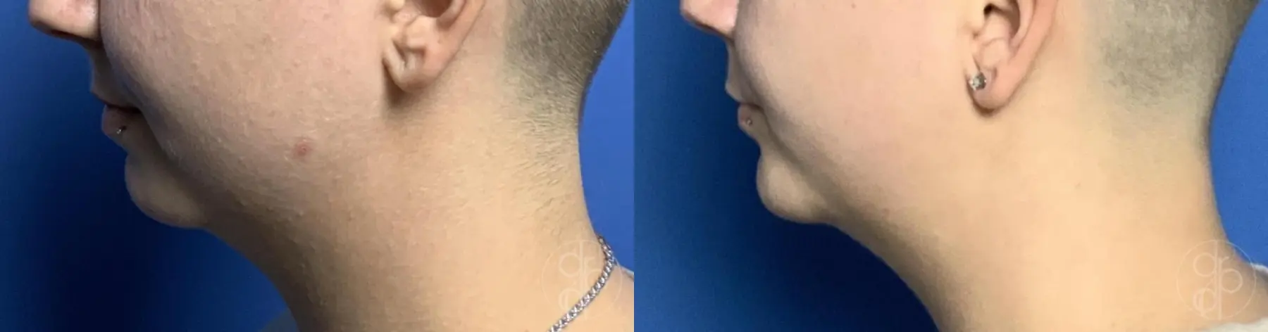 patient 12469 chin augmentation before and after result - Before and After 5
