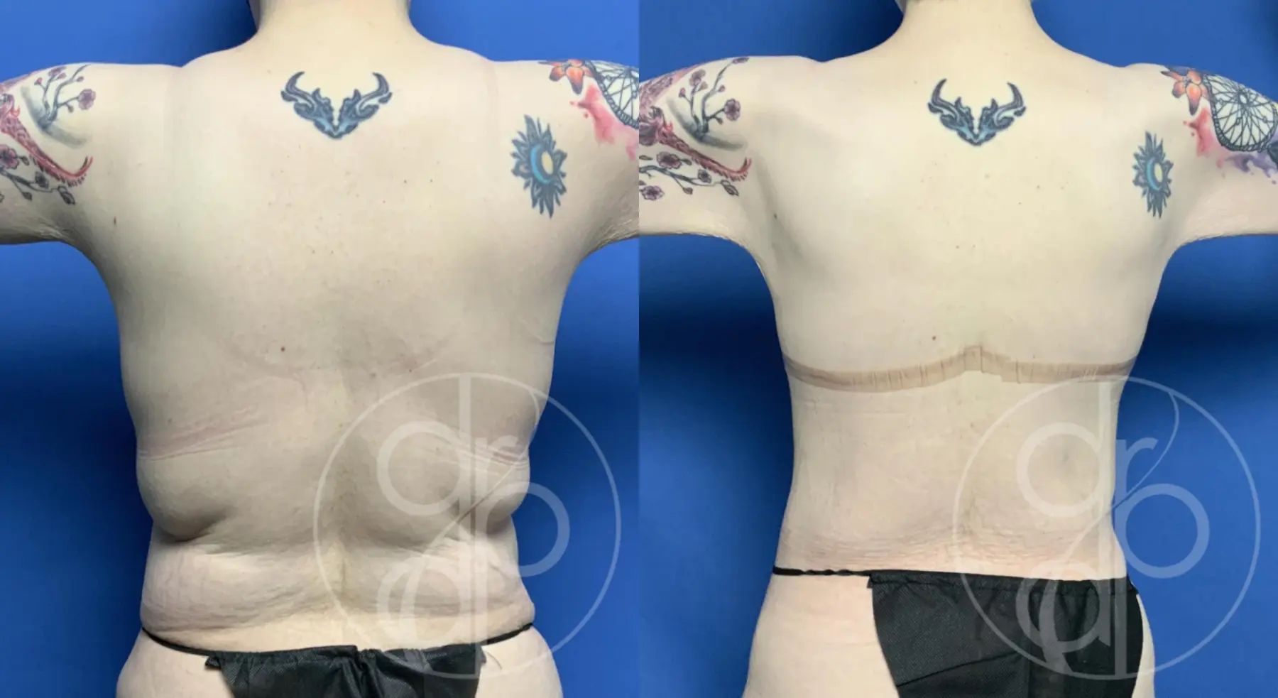 patient 12449 combo body procedure before and after result - Before and After 4