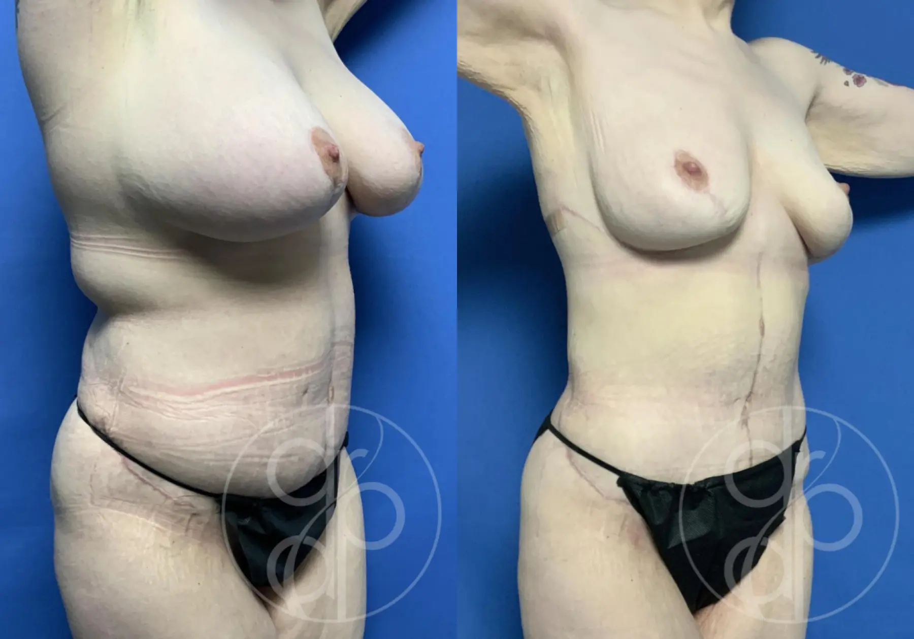 patient 12449 combo body procedure before and after result - Before and After 2