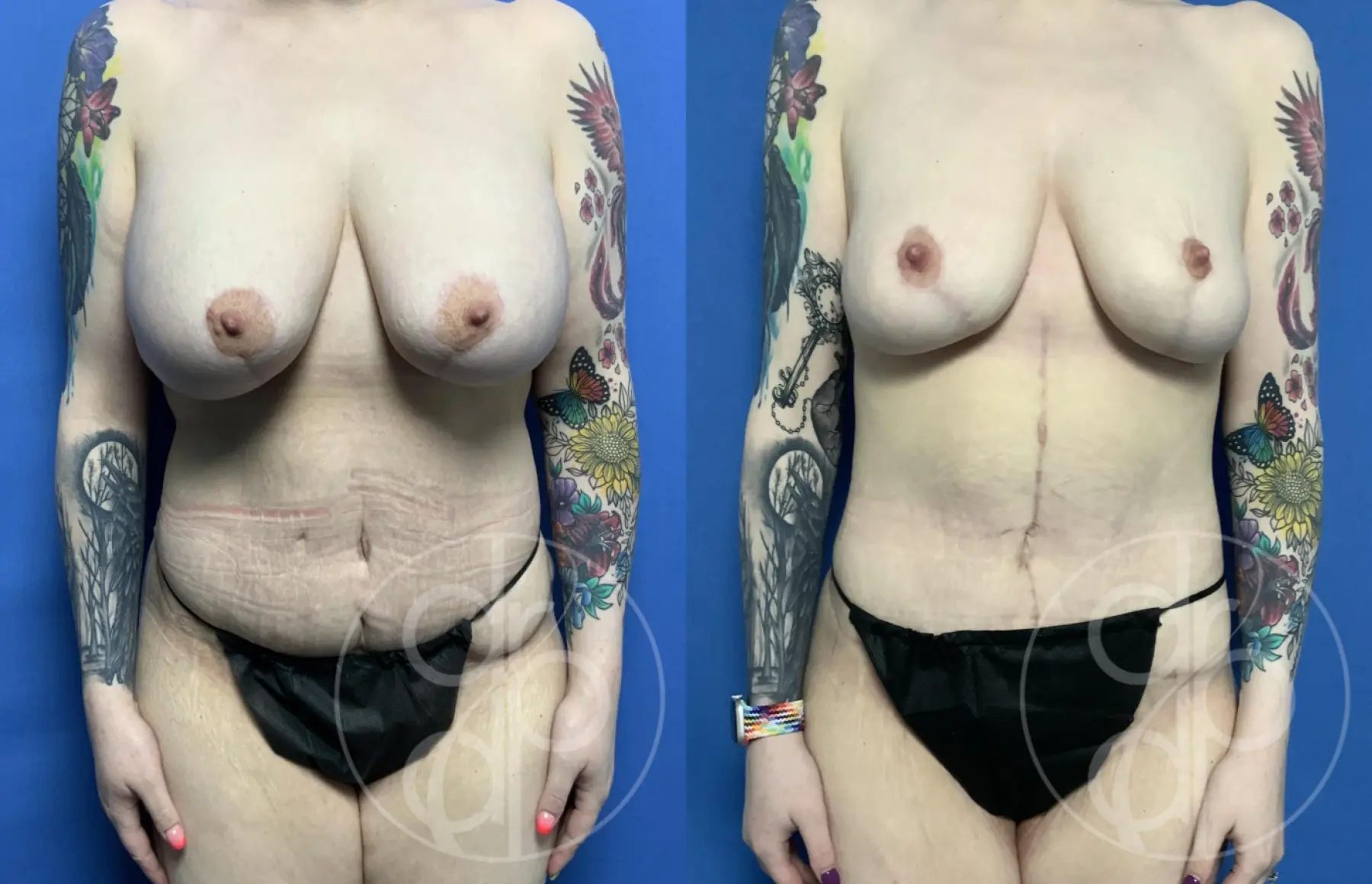 patient 12449 combo body procedure before and after result - Before and After 1