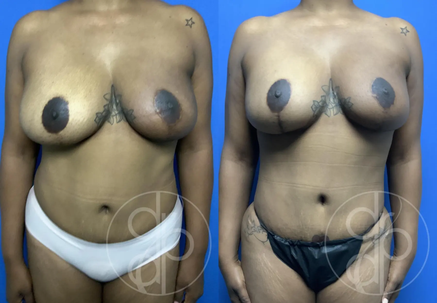 patient 12687 combo body procedure before and after result - Before and After 1