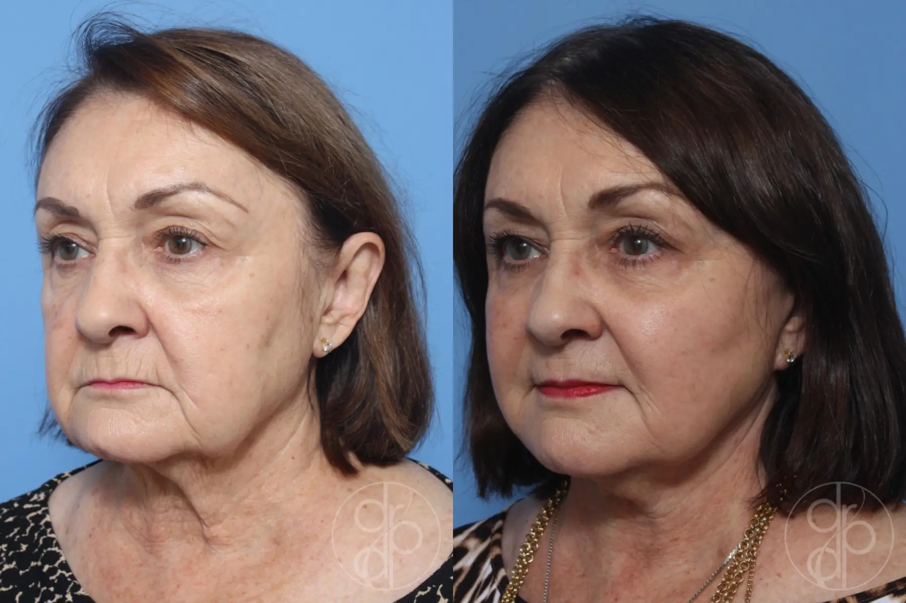 patient 12406 facelift before and after result - Before and After 2