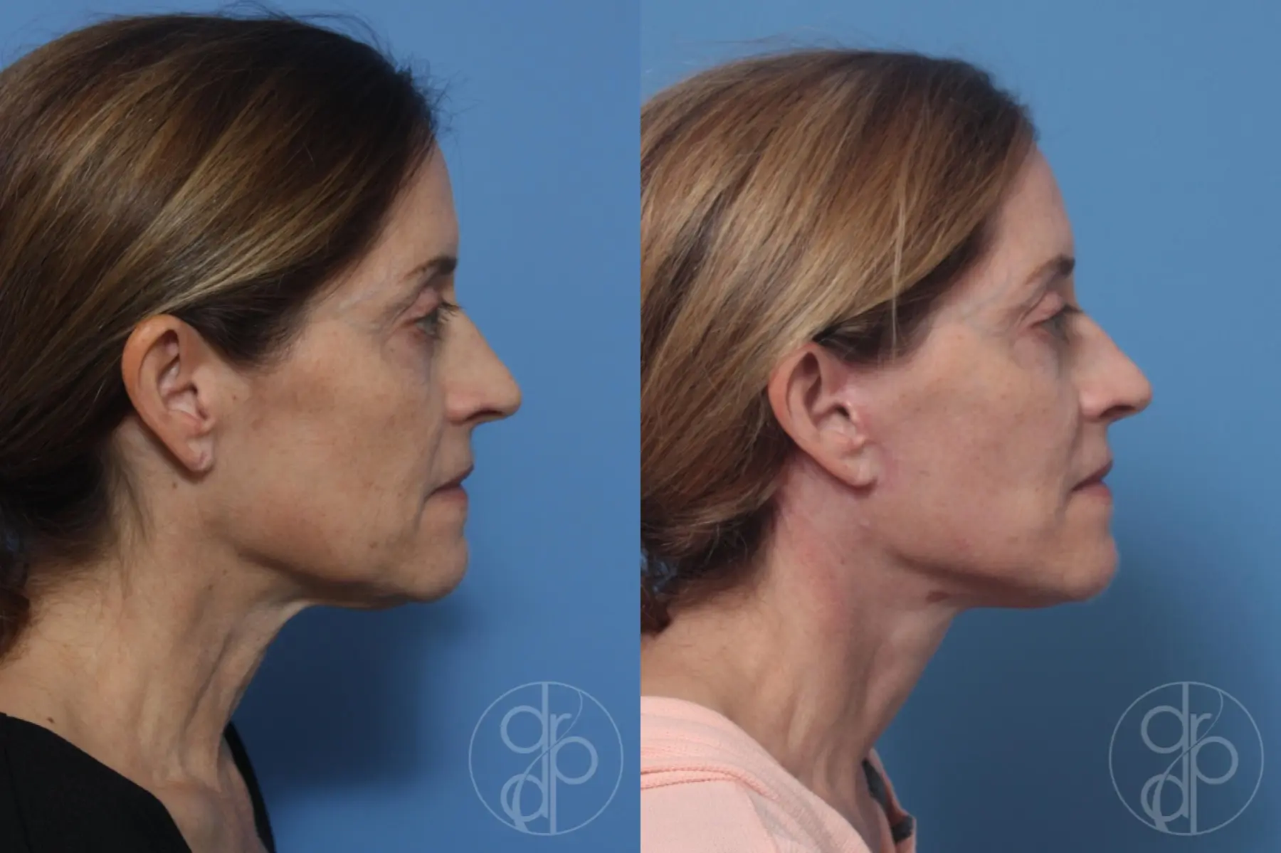patient 10319 facelift before and after result - Before and After 3