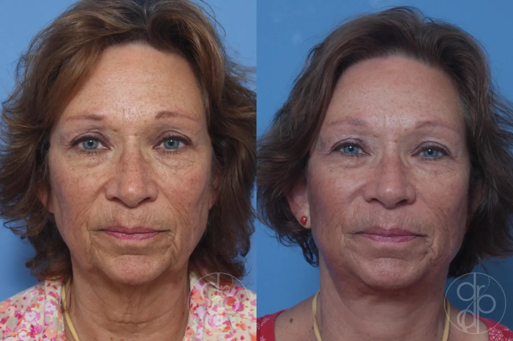 patient 10247 facelift before and after result - Before and After 1