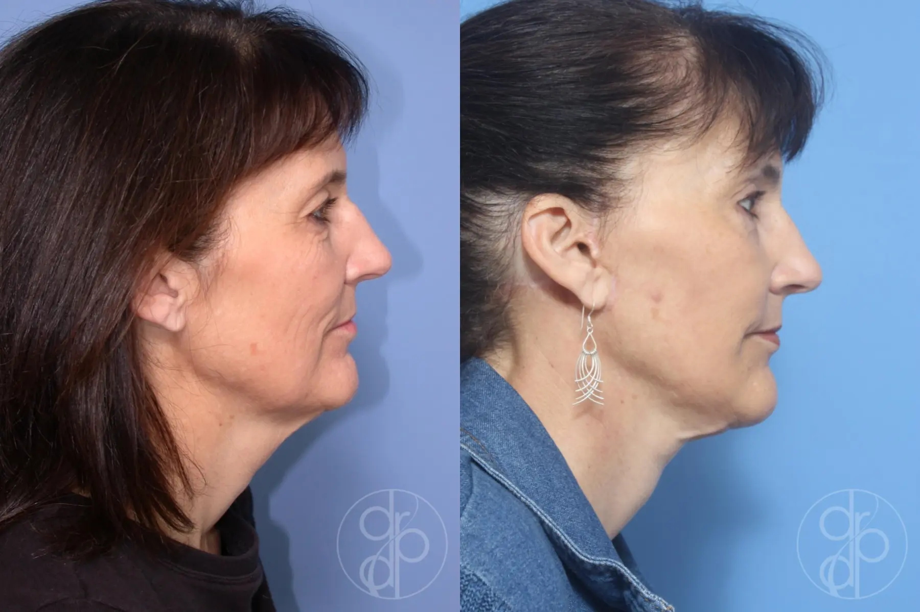 patient 12915 facelift before and after result - Before and After 2