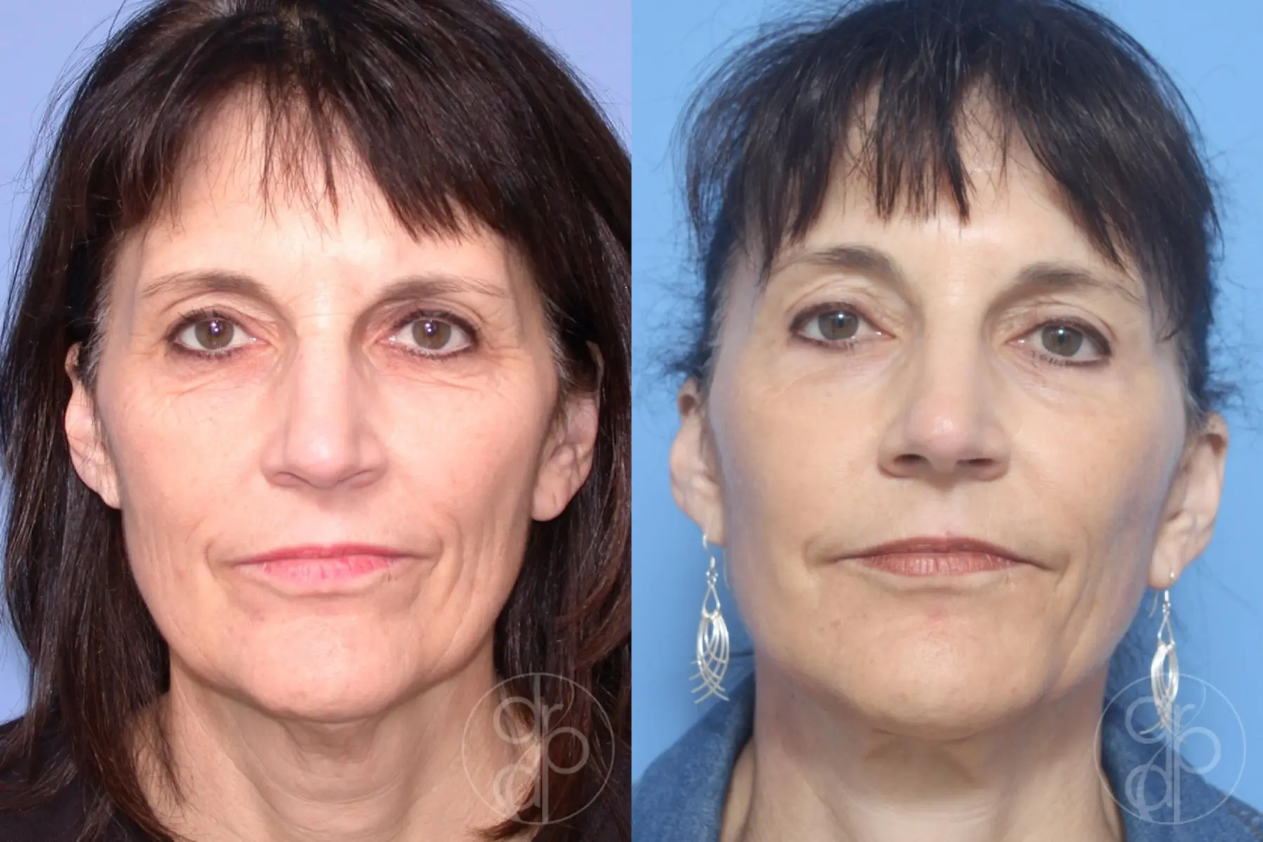 patient 12915 facelift before and after result - Before and After 1