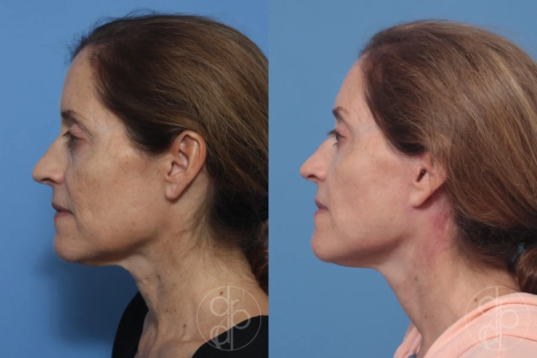 patient 10319 facelift before and after result - Before and After 2