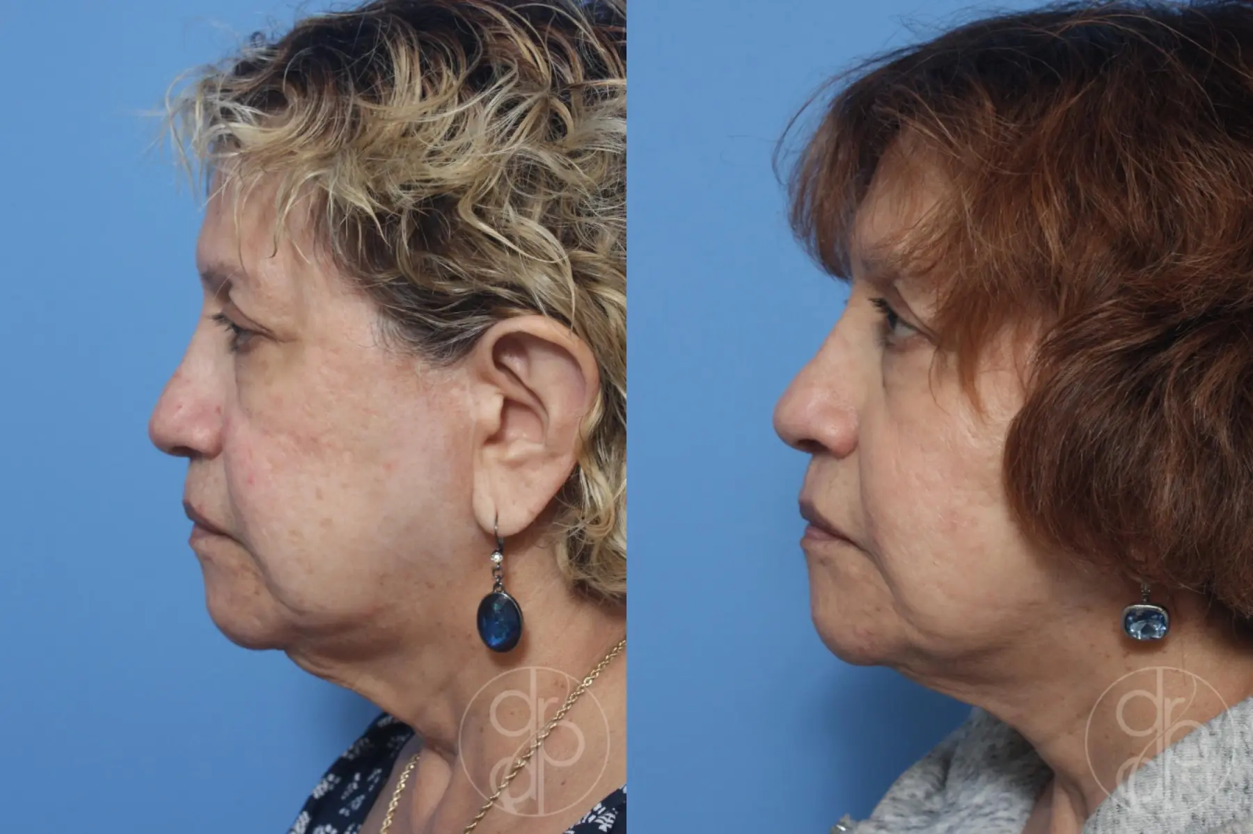 patient 12956 facelift before and after result - Before and After 2