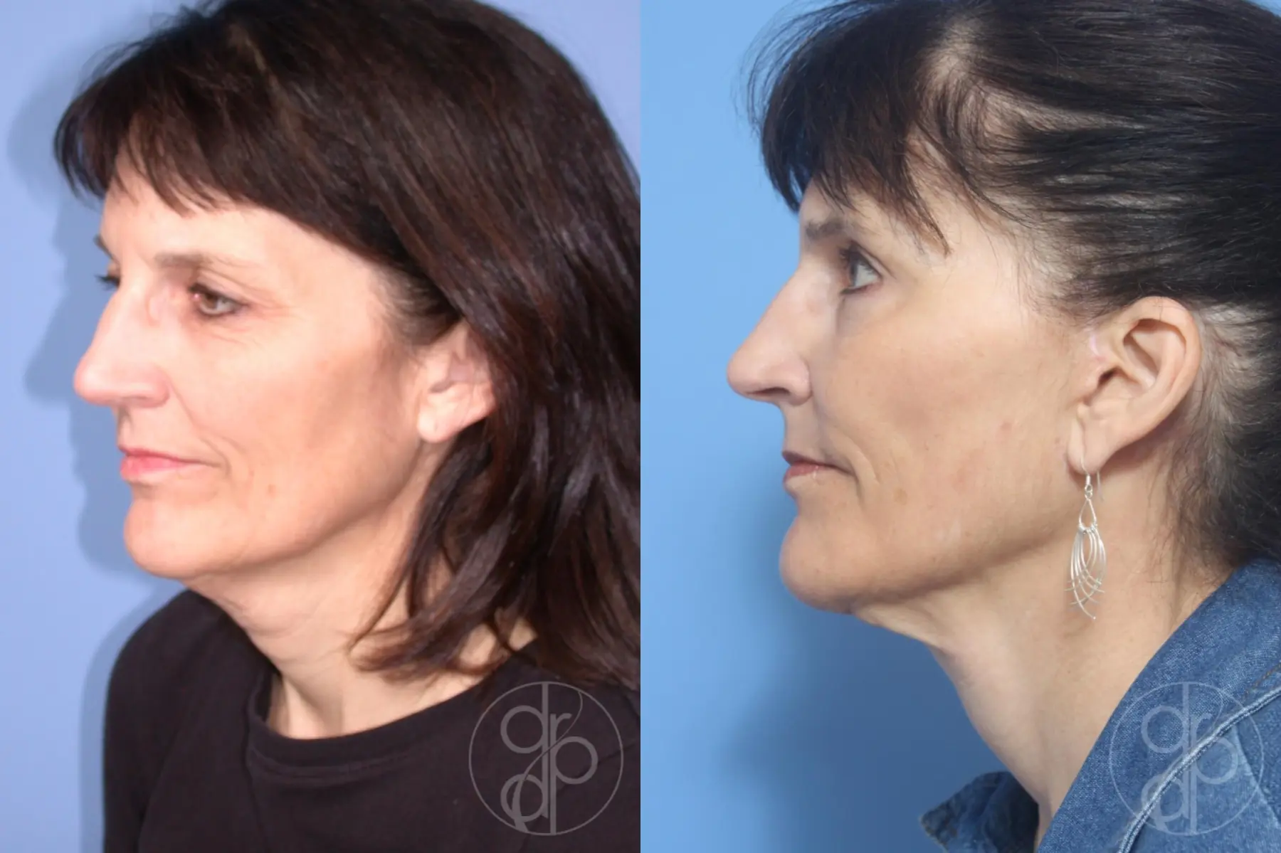 patient 12915 facelift before and after result - Before and After 3