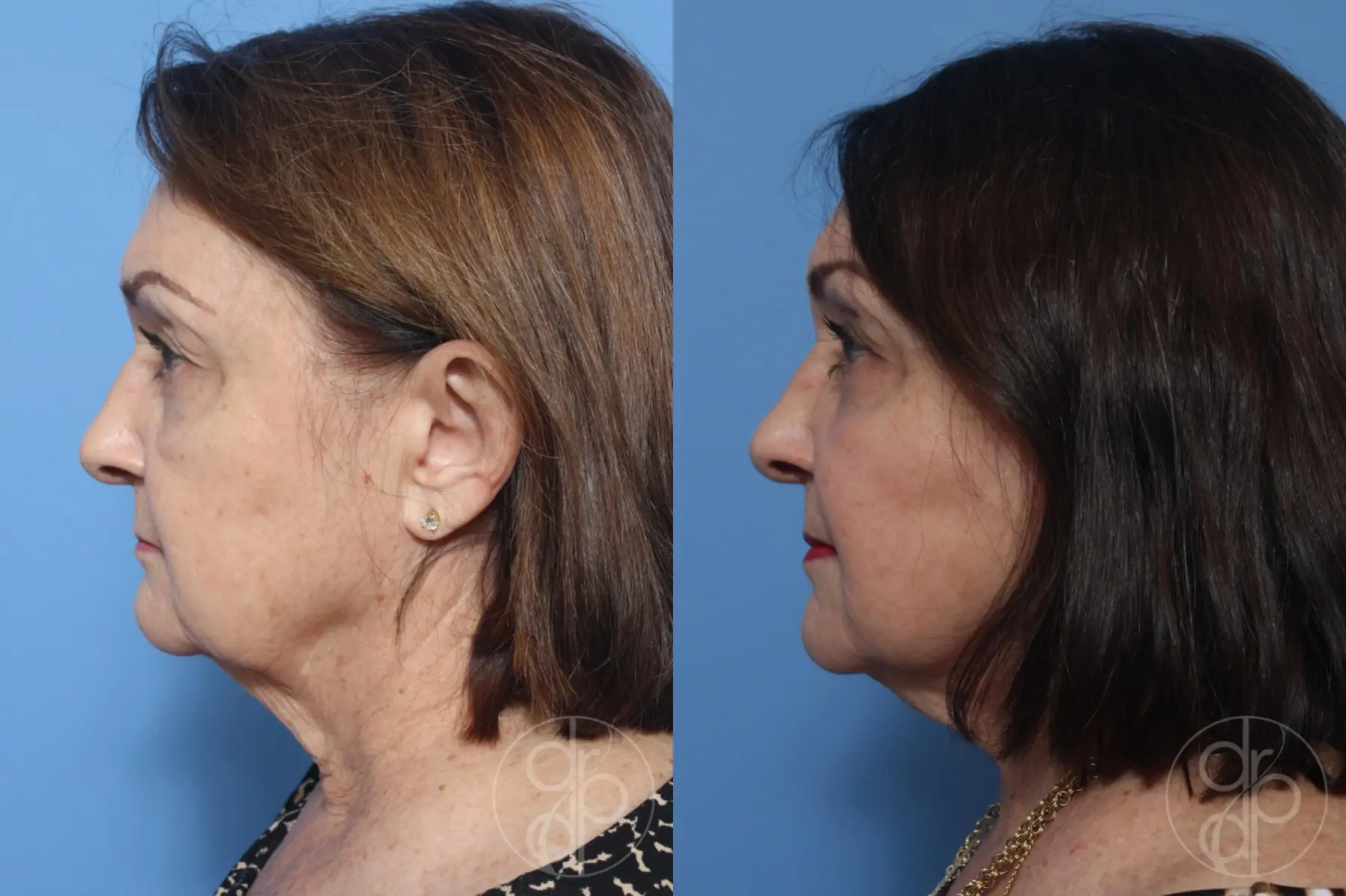 patient 12406 facelift before and after result - Before and After 5