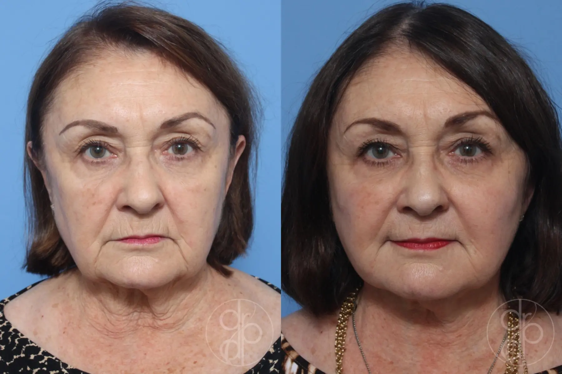 patient 12406 facelift before and after result - Before and After