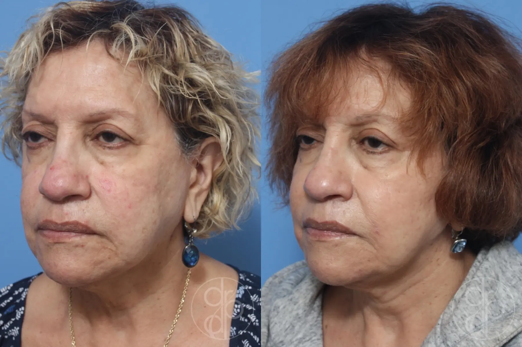patient 12956 facelift before and after result - Before and After 4