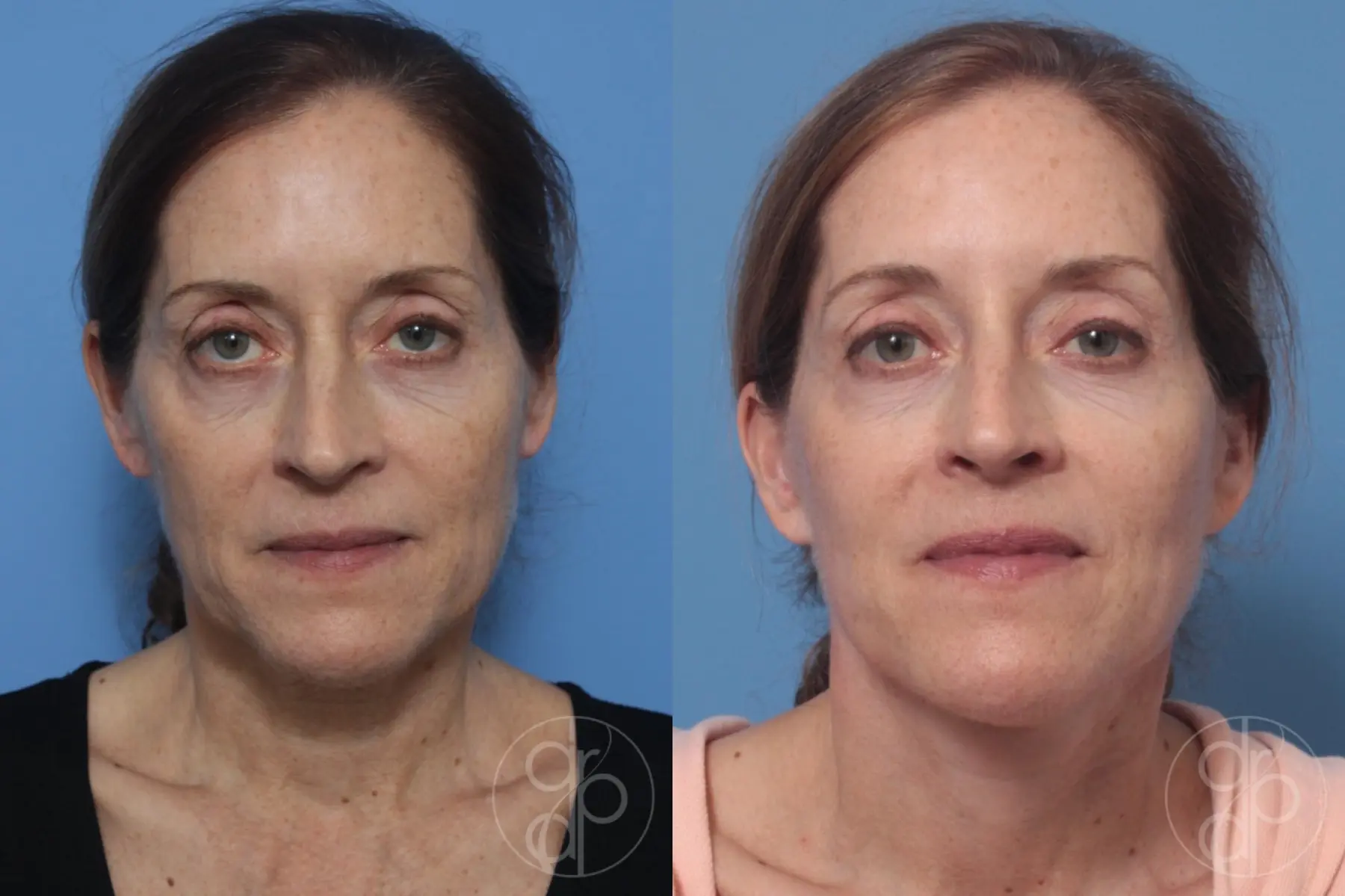 patient 10319 facelift before and after result - Before and After 1