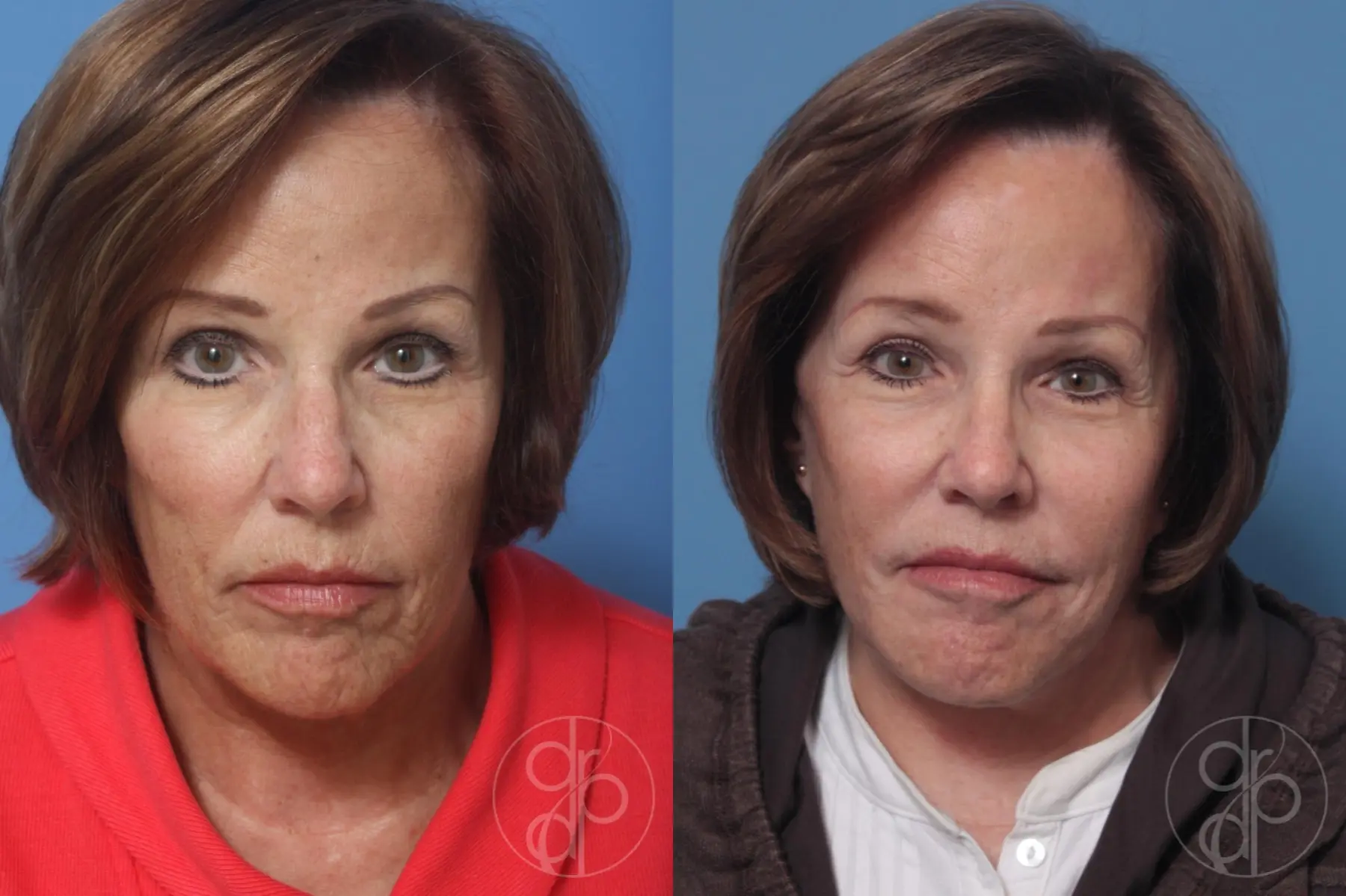 patient 10505 facelift before and after result - Before and After