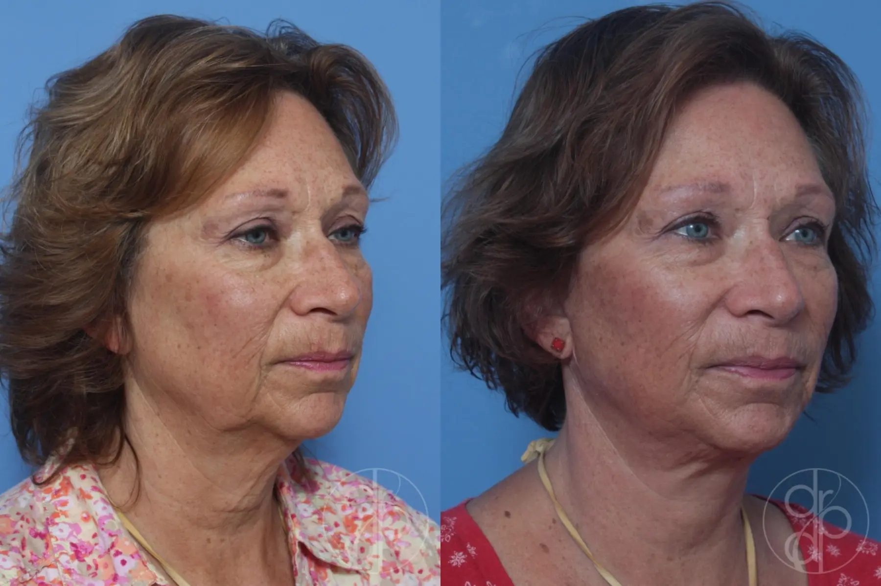 patient 10247 facelift before and after result - Before and After 4