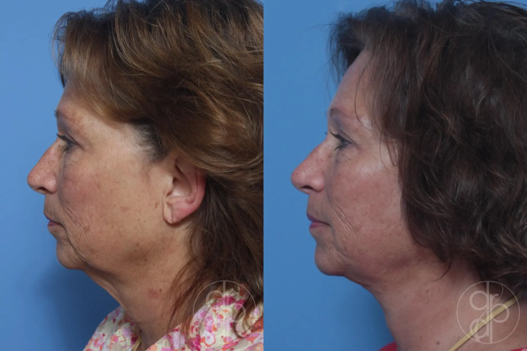 patient 10247 facelift before and after result - Before and After 5