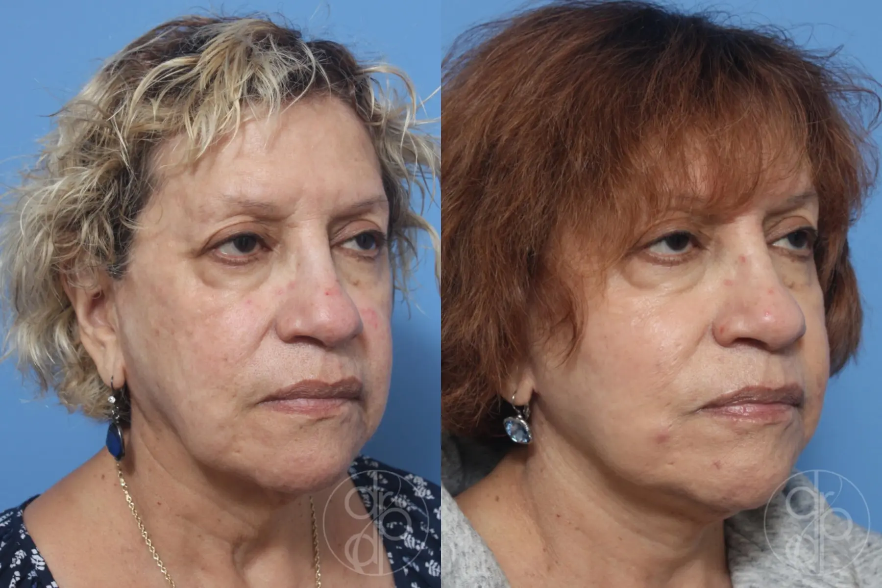 patient 12956 facelift before and after result - Before and After 5