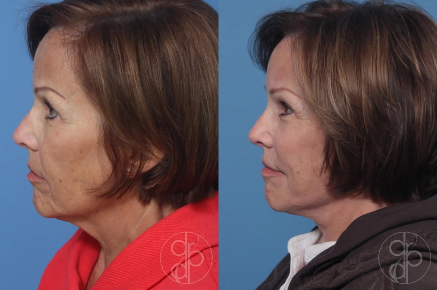 patient 10505 facelift before and after result - Before and After 5