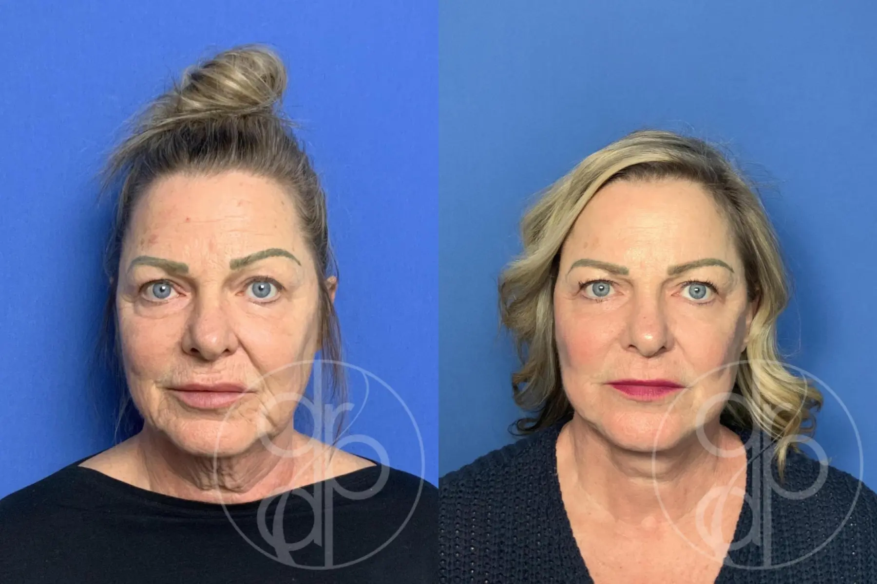 patient 13950 facelift before and after result - Before and After