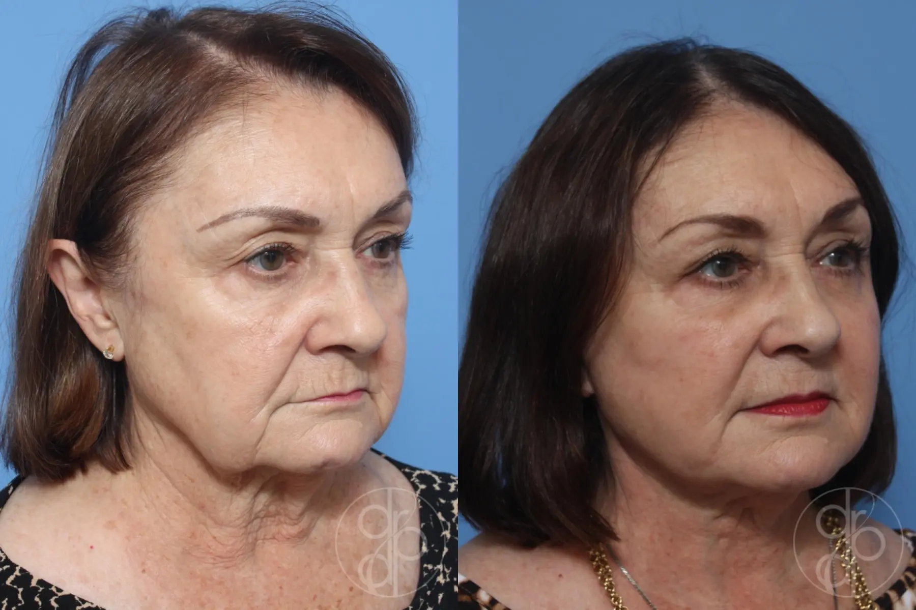 patient 12406 facelift before and after result - Before and After 3