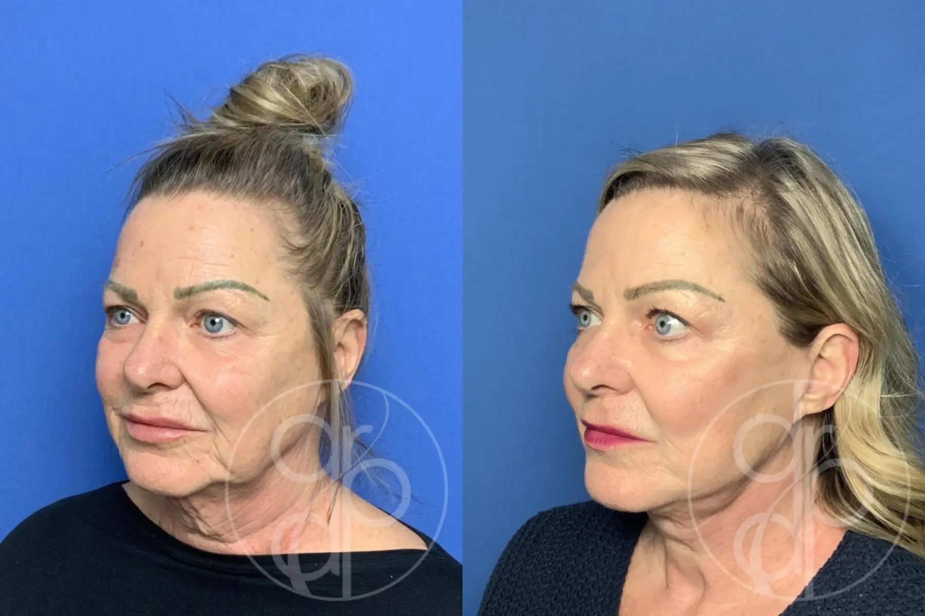 Facelift: Patient 7 - Before and After 4
