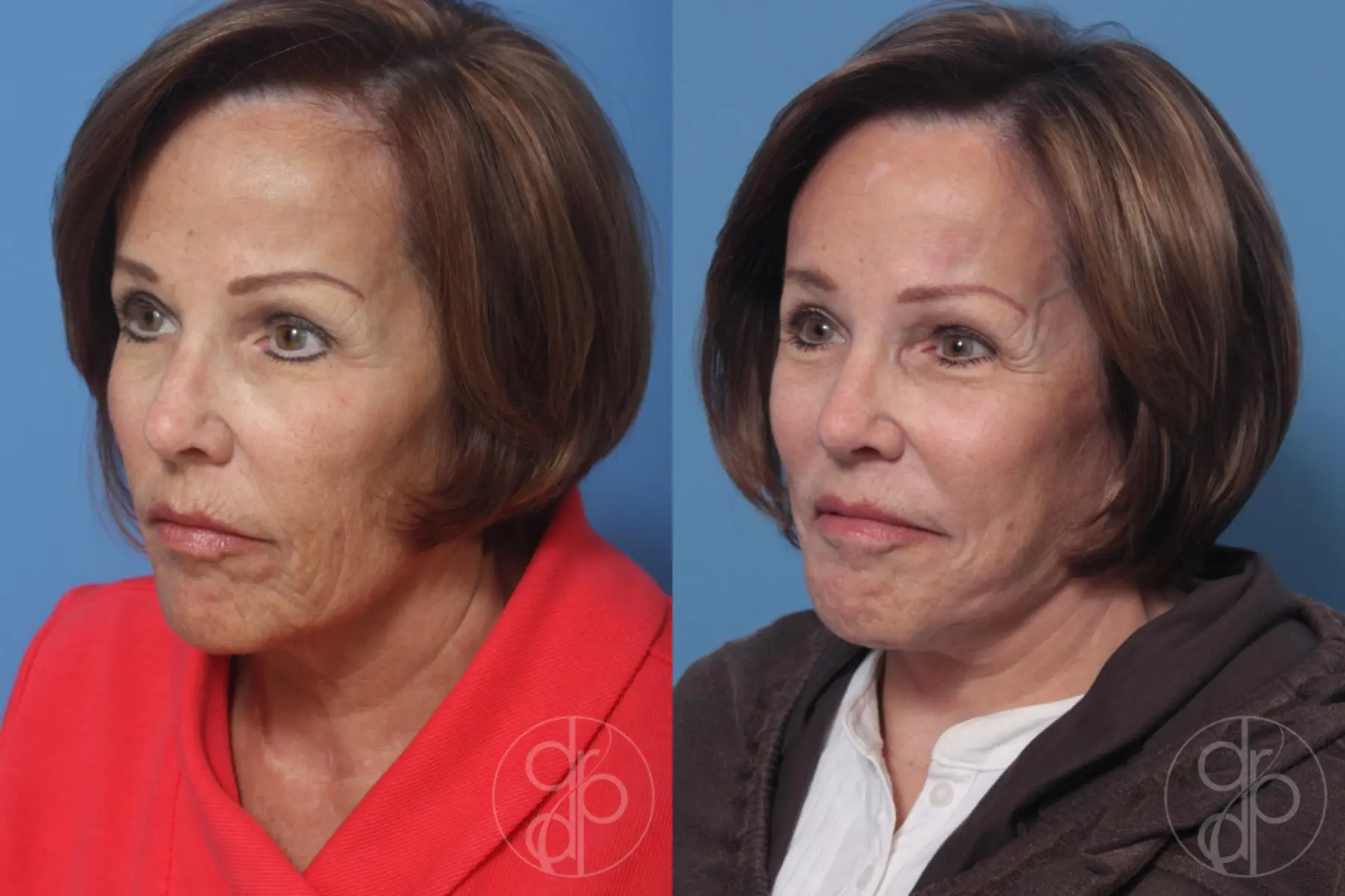 patient 10505 facelift before and after result - Before and After 2