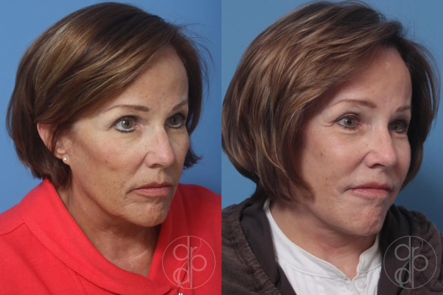 patient 10505 facelift before and after result - Before and After 3