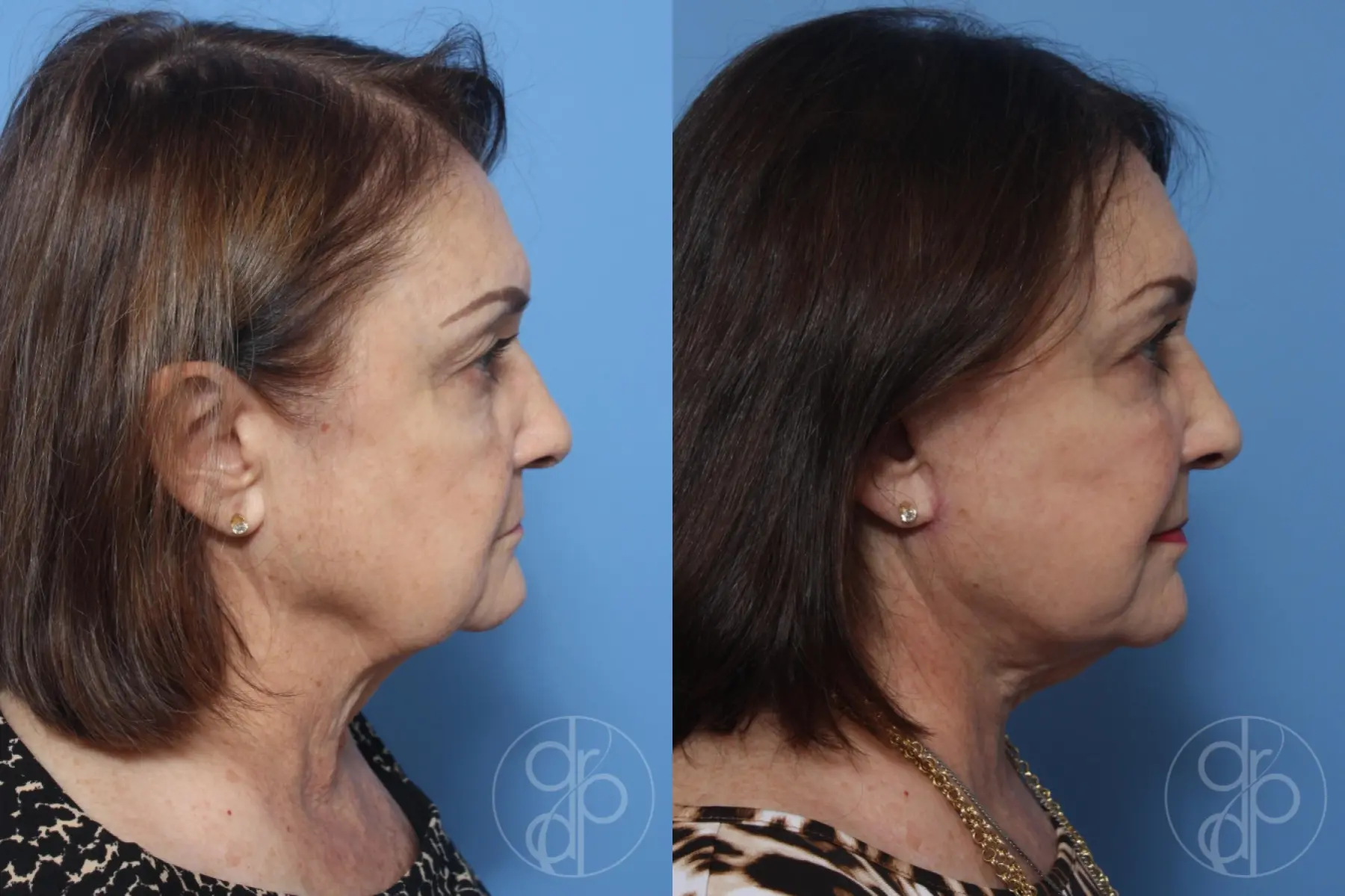 patient 12406 facelift before and after result - Before and After 4