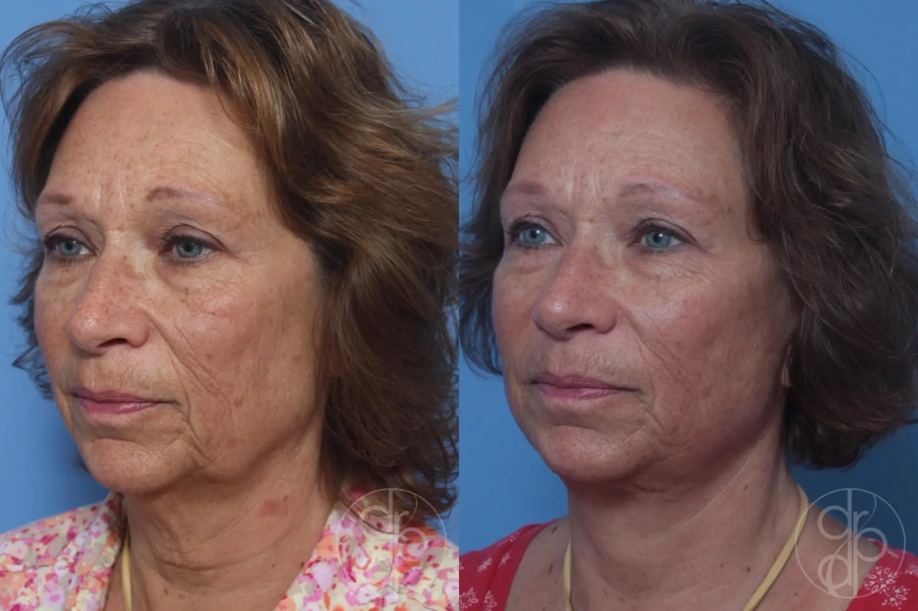 patient 10247 facelift before and after result - Before and After 2