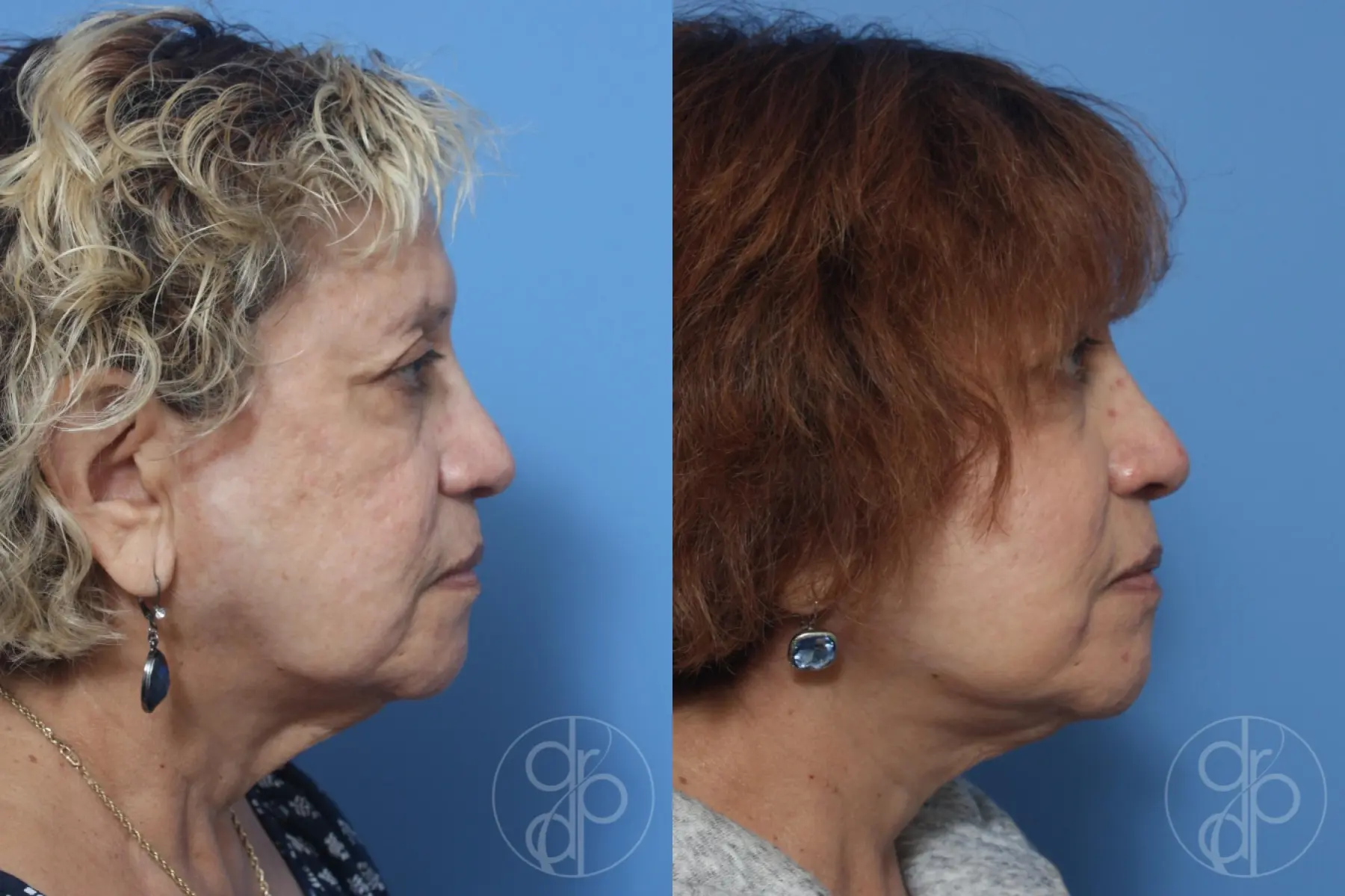 patient 12956 facelift before and after result - Before and After 3