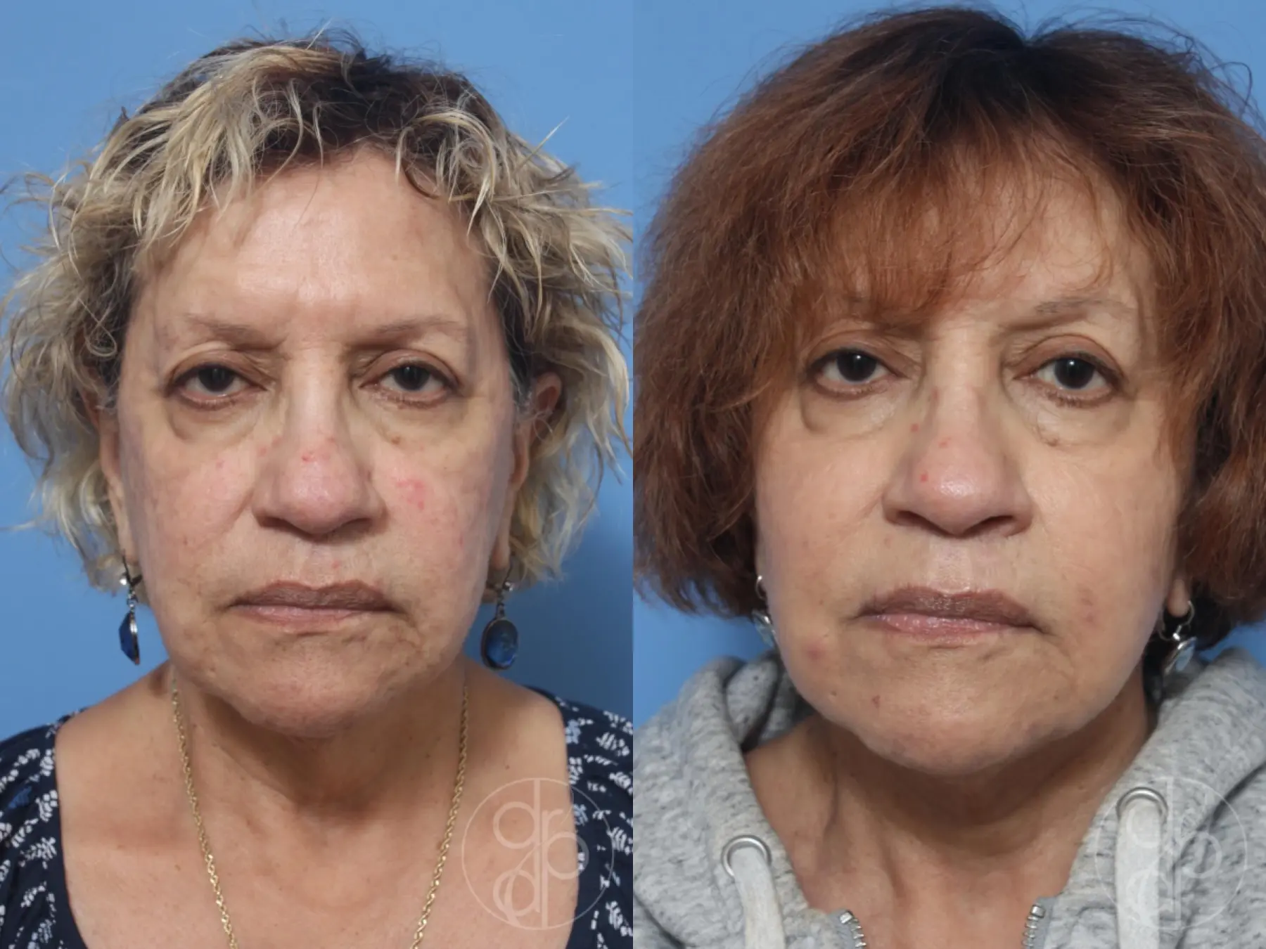 patient 12956 facelift before and after result - Before and After