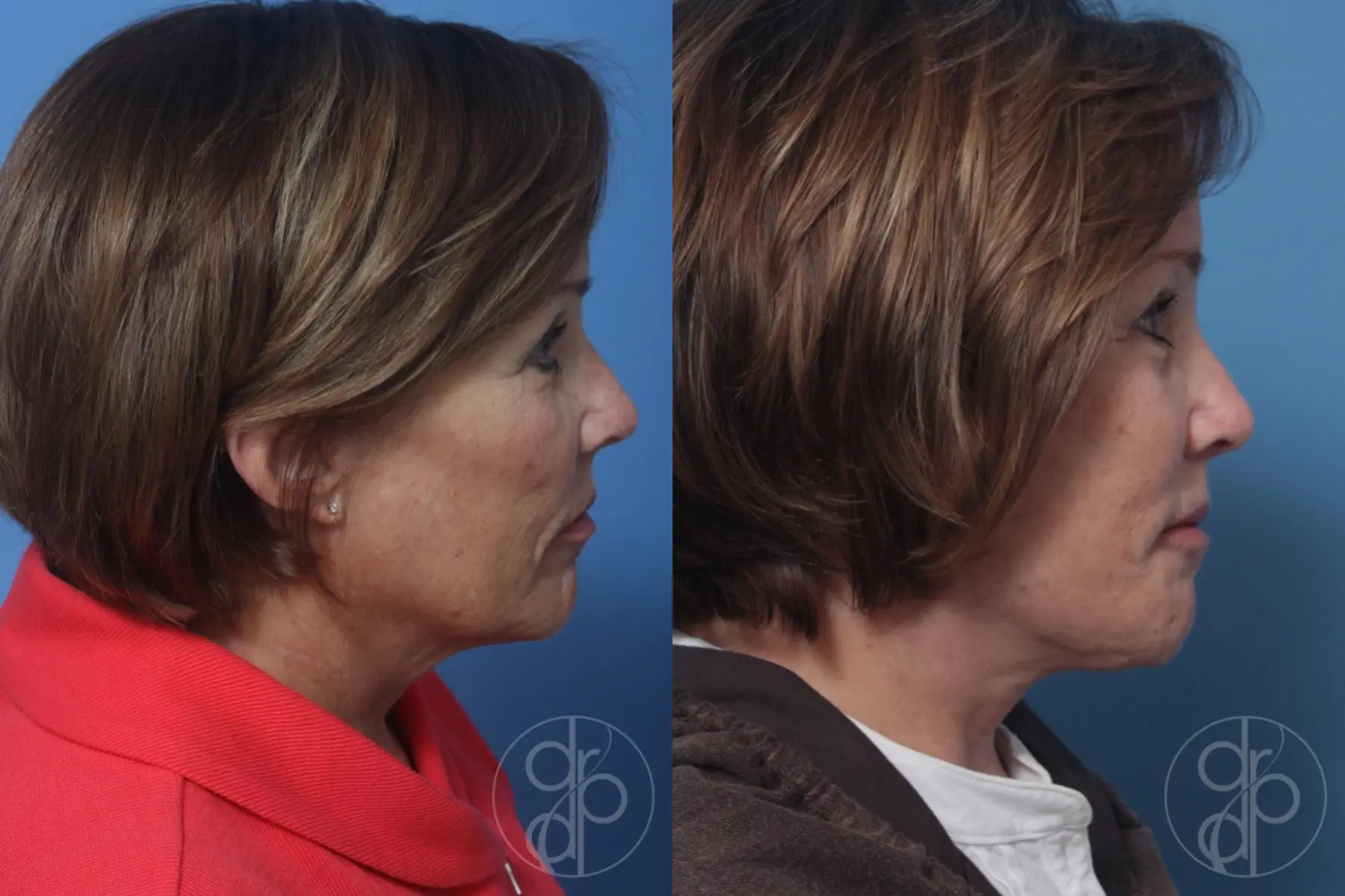 patient 10505 facelift before and after result - Before and After 4