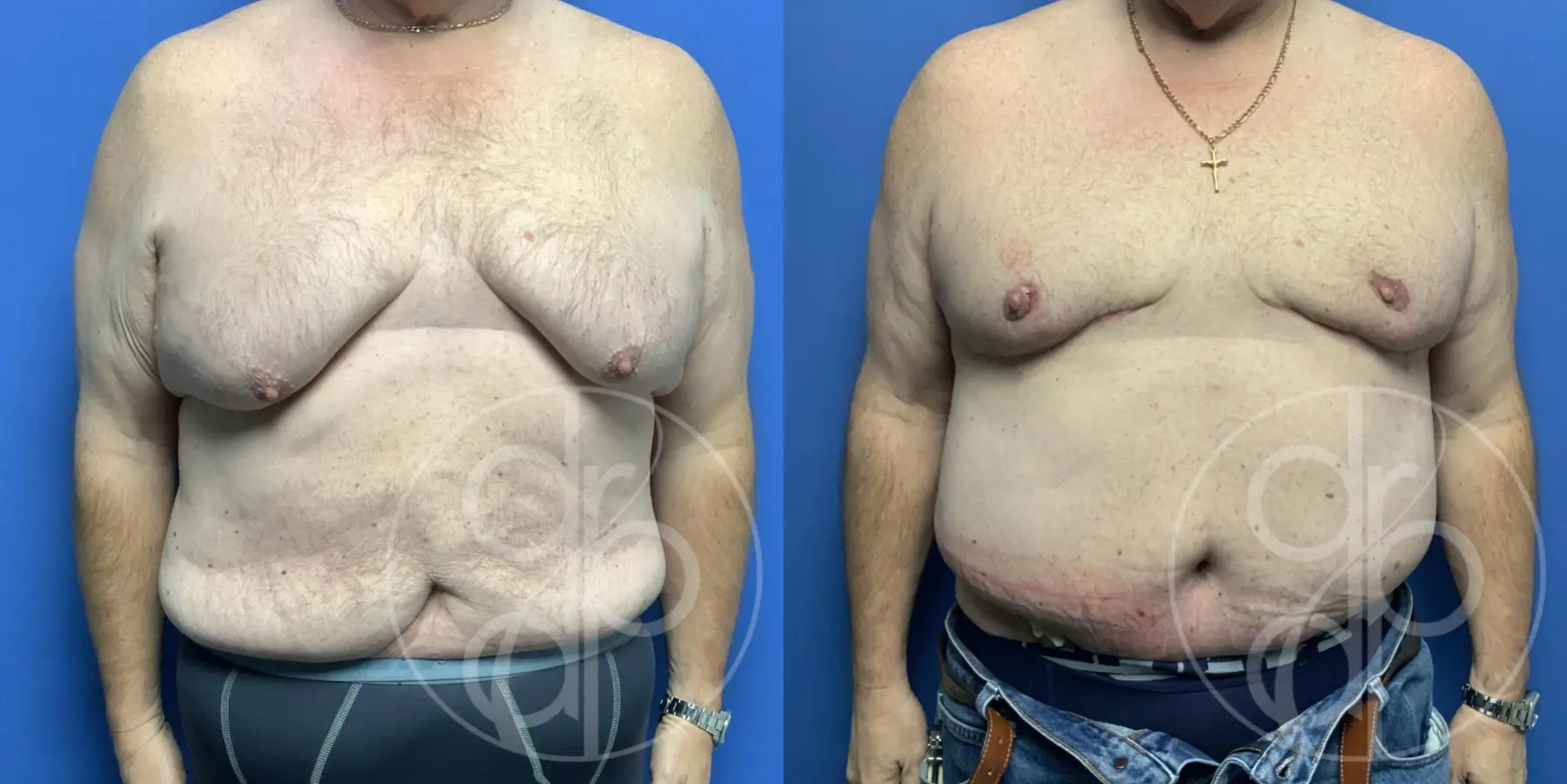 patient 12718 gynecomastia before and after result - Before and After