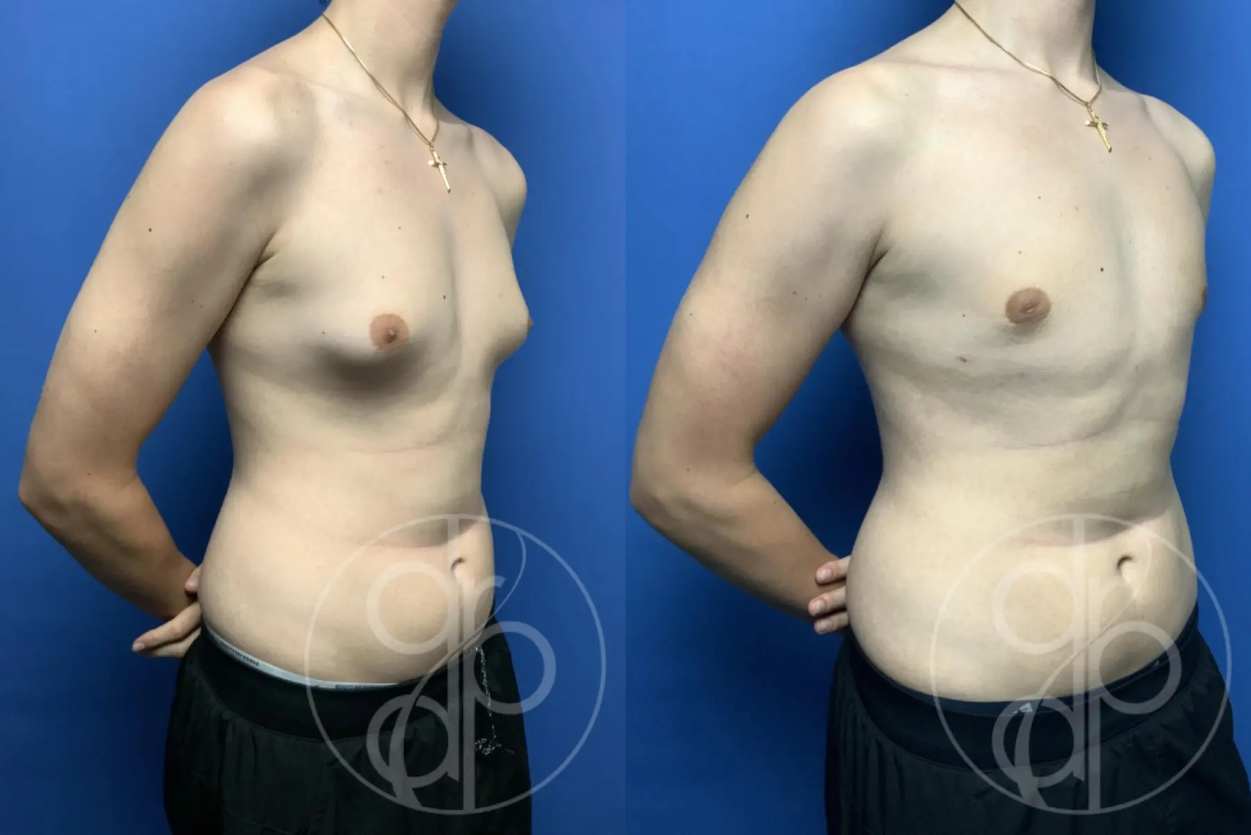 gynecomastia before and after result - Before and After 2