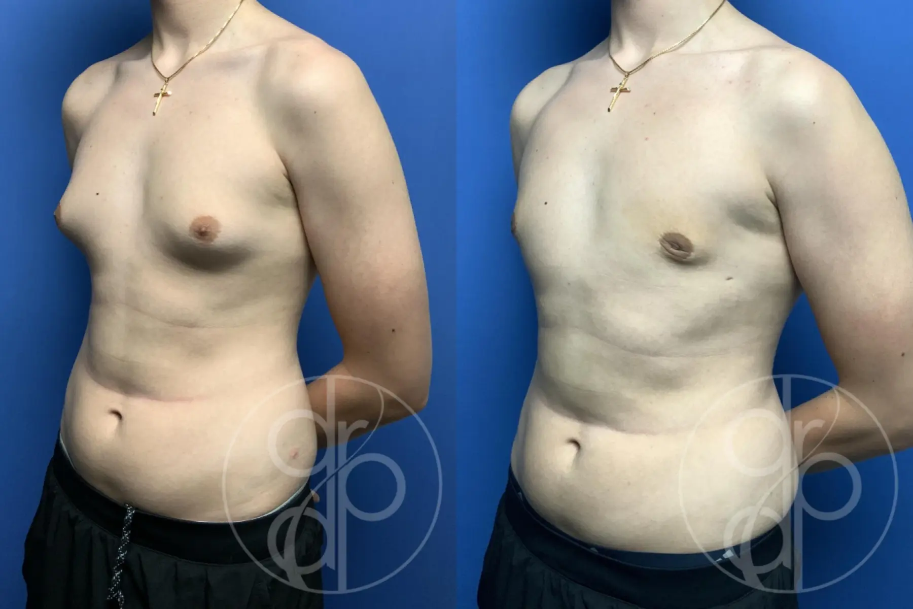 gynecomastia before and after result - Before and After 3