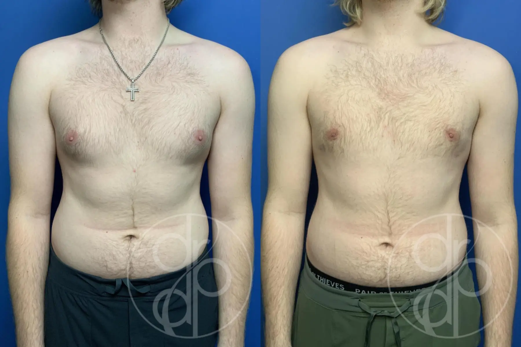 Gynecomastia: Patient 4 - Before and After 1