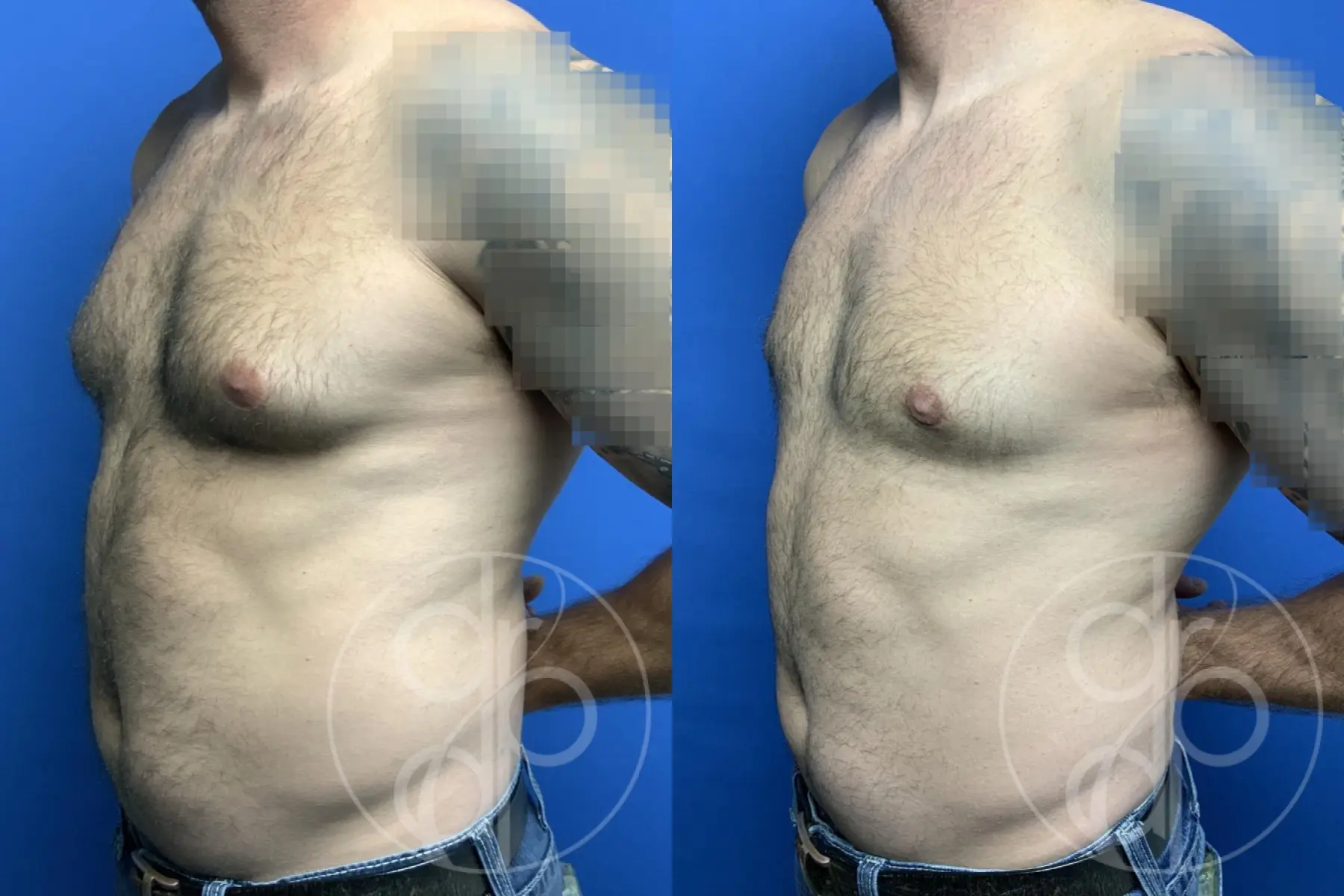 patient 13799 gynecomastia before and after result - Before and After 3