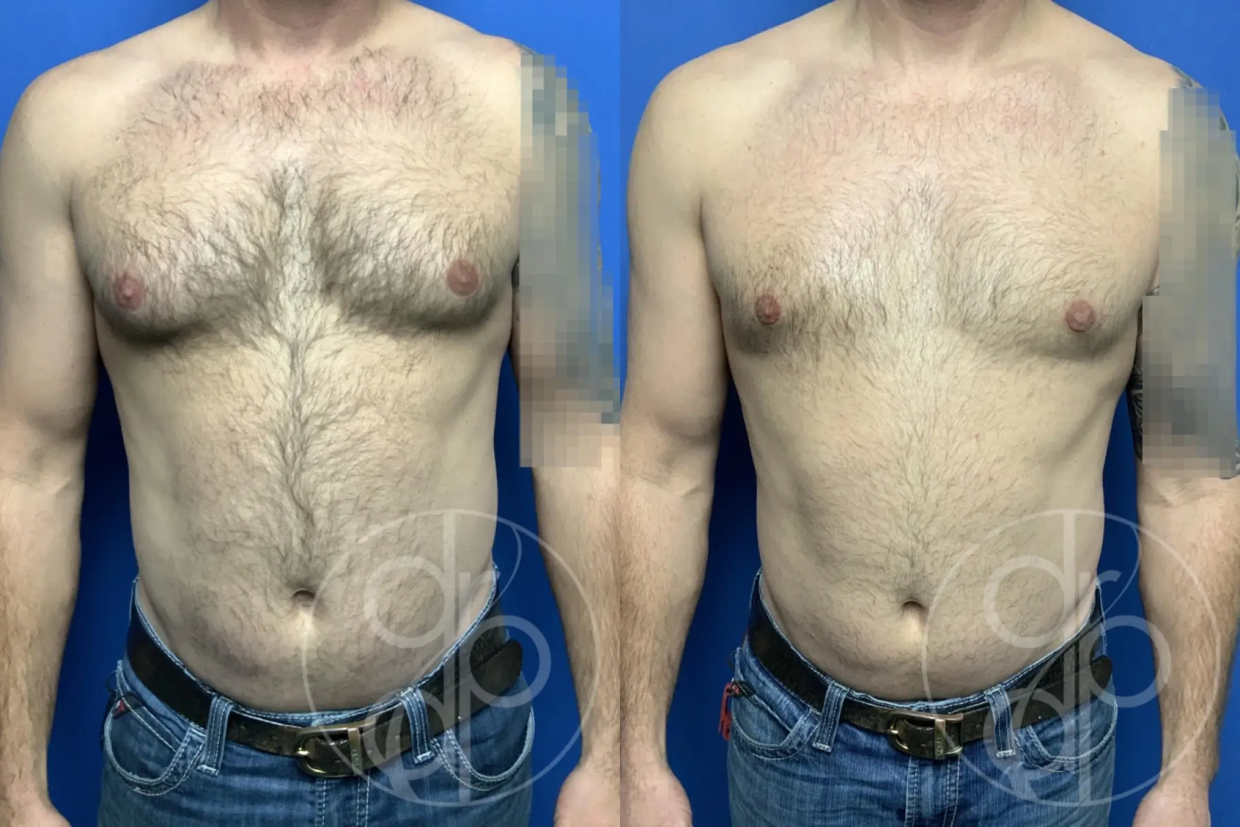 patient 13799 gynecomastia before and after result - Before and After