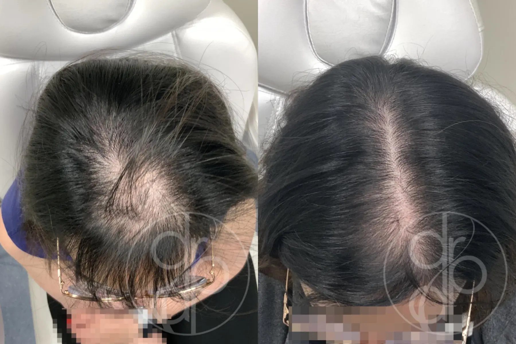 patient 12679 hair loss treatment before and after result - Before and After
