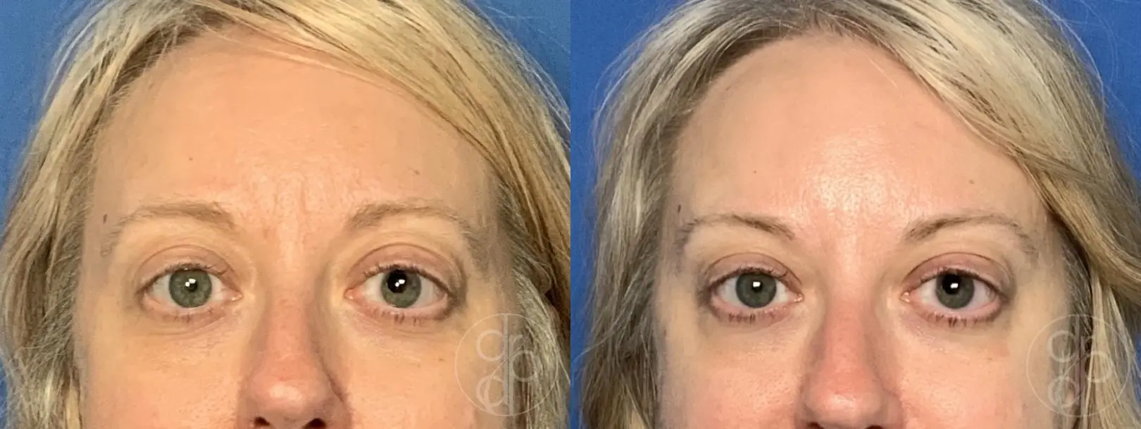 patient 14169 injectables before and after result - Before and After 1