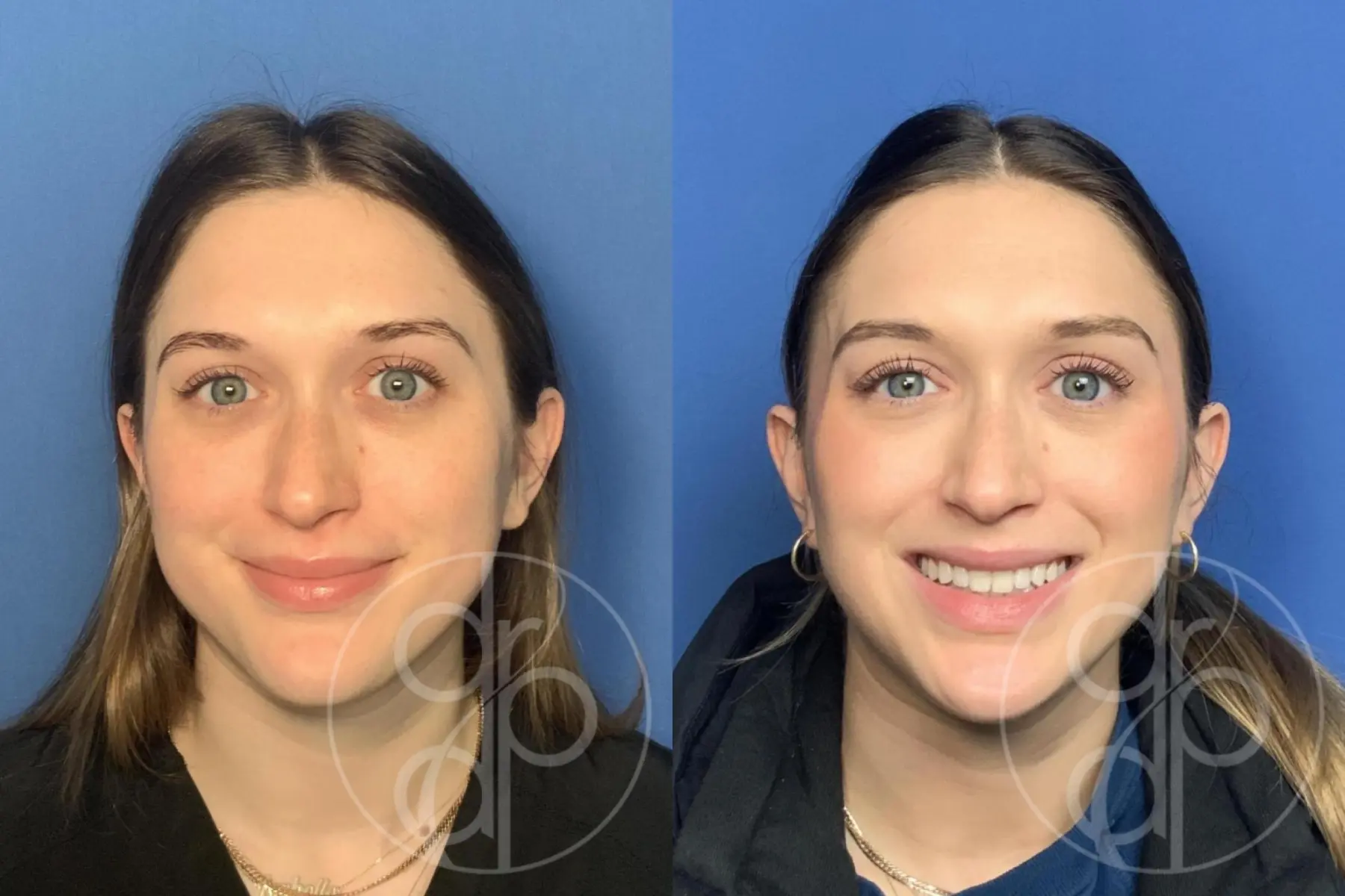 Injectables: Patient 11 - Before and After 2