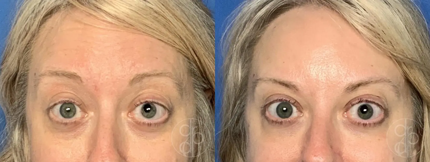 patient 14169 injectables before and after result - Before and After 2