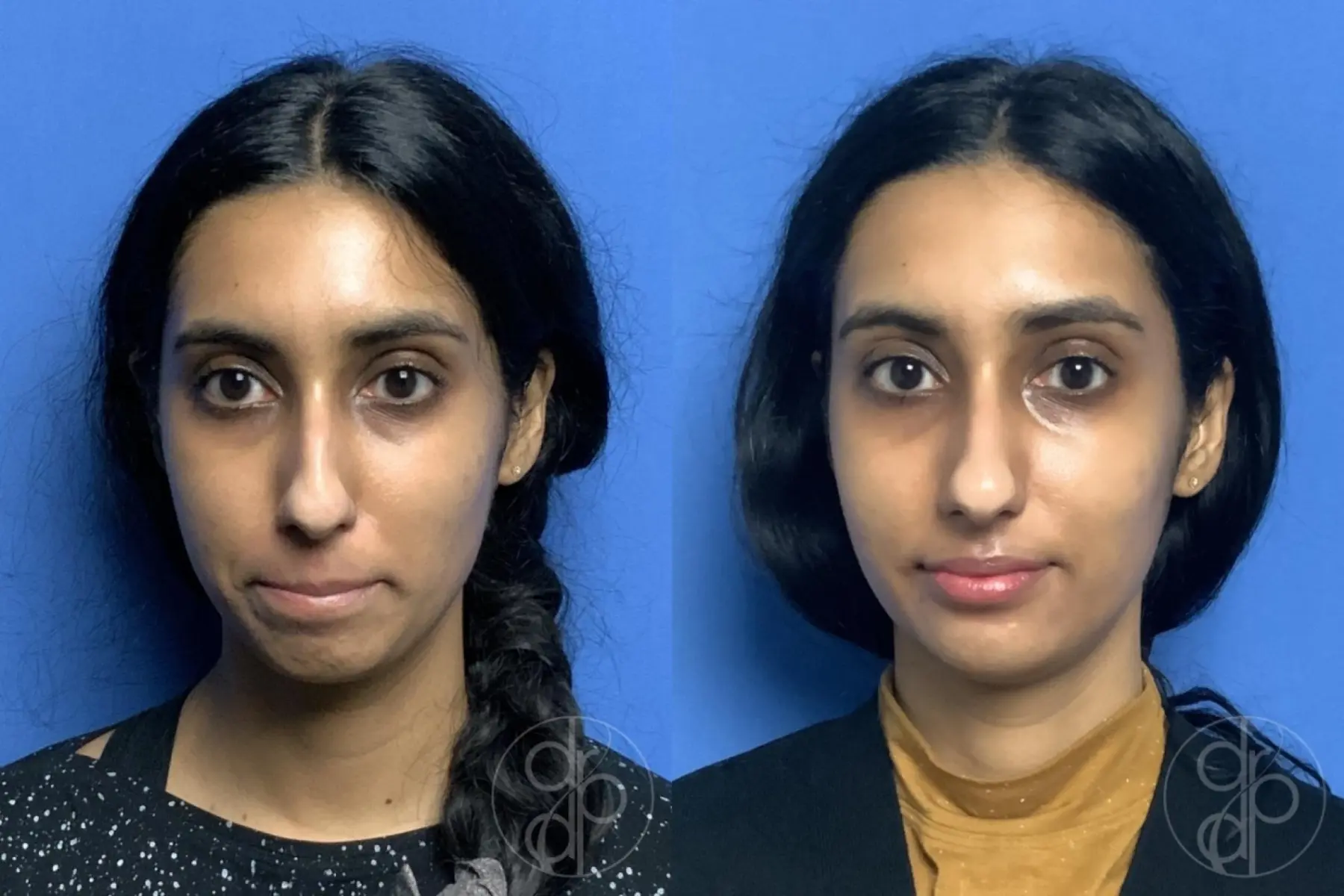 patient 12325 fillers before and after result - Before and After 1